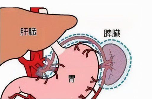 乙肝患者查出脾大医生说已经到了纤维化是真的吗?