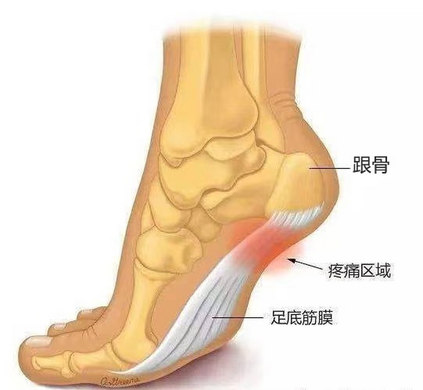 如果你有以上情况,一定要引起重视,足底筋膜炎可