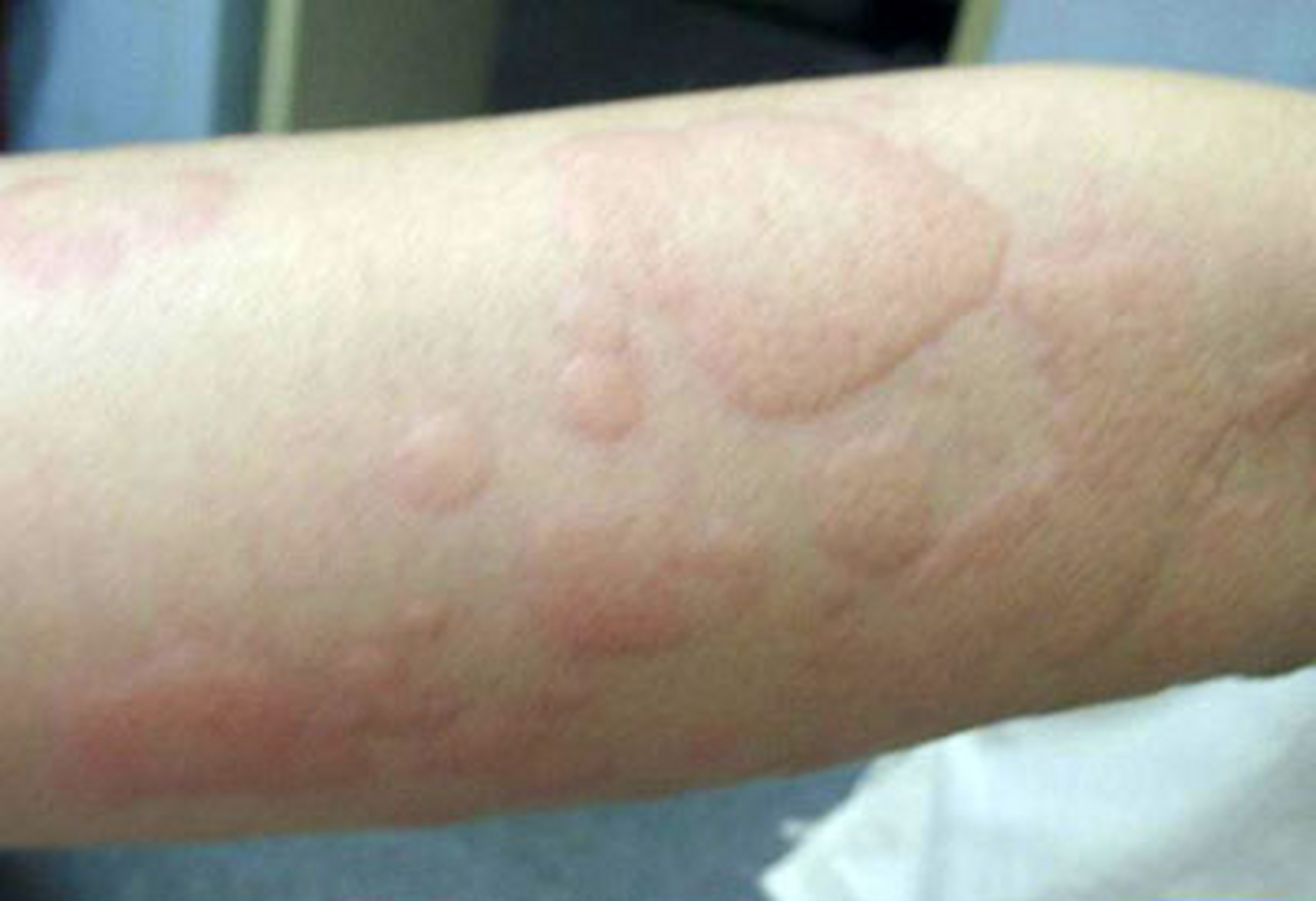 小儿荨麻疹可以自愈吗?