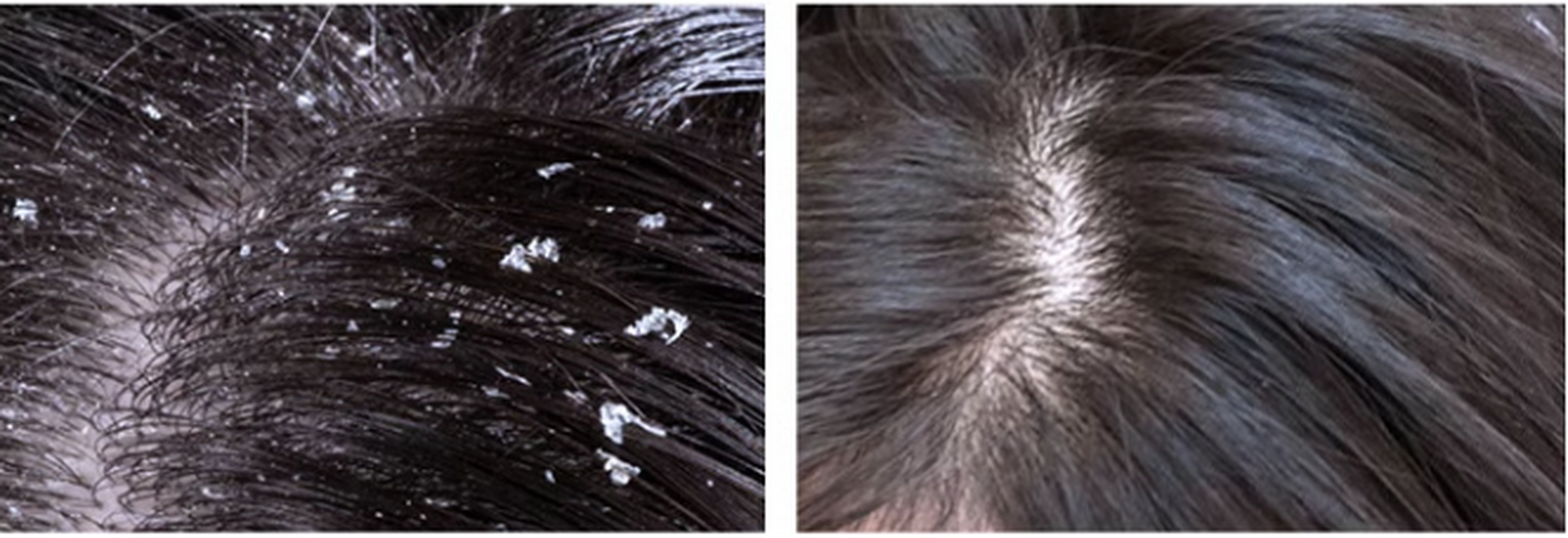 去屑洗发水可以一直用吗?