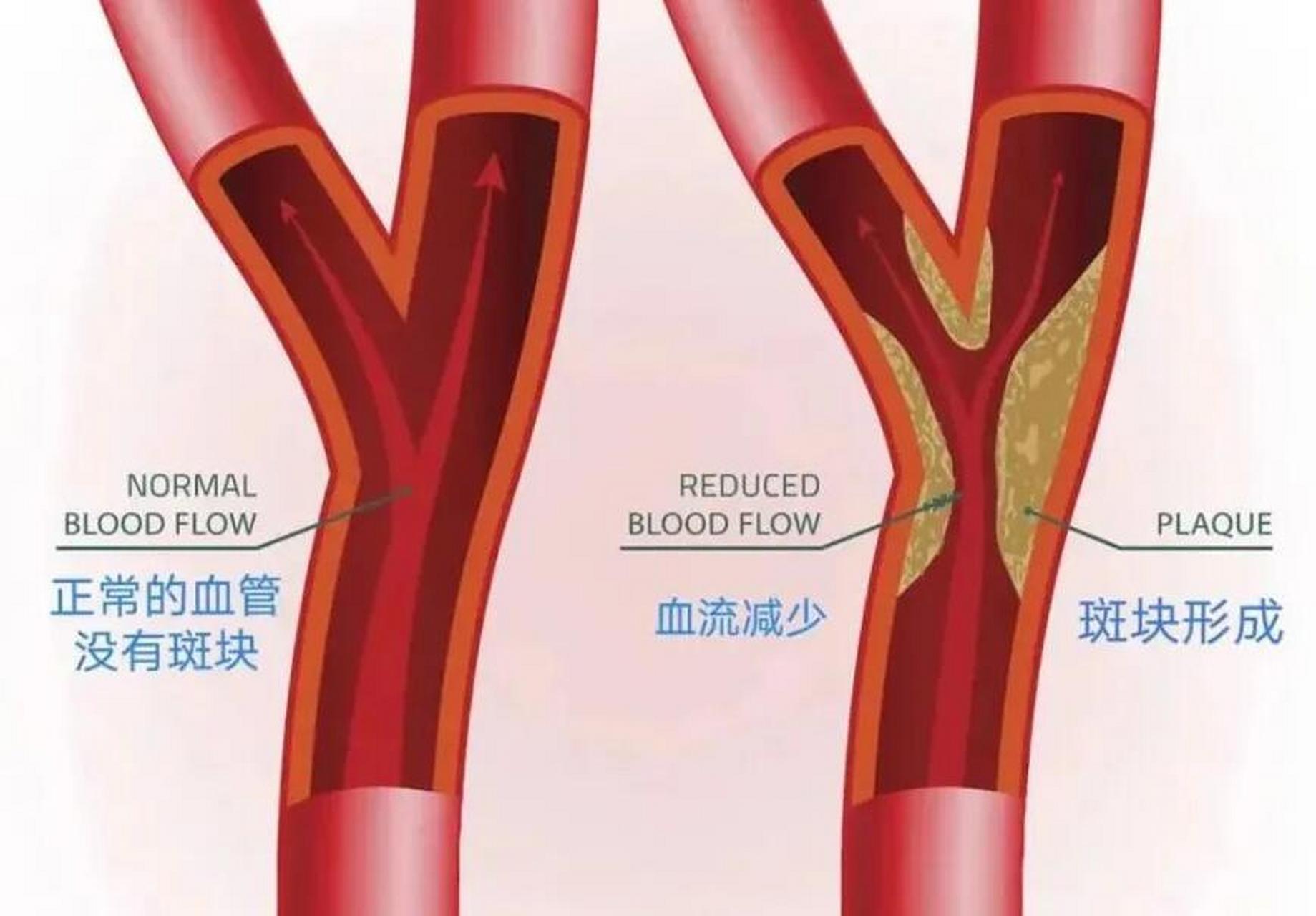 双侧颈动脉有斑块 血脂高,简单6味药化脂降浊,巧妙控制斑块 58岁的侯