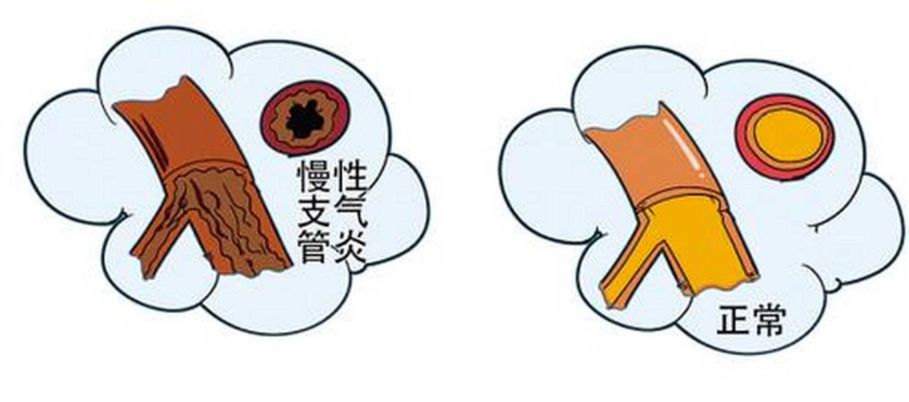 慢性支气管炎患者为什么早晨咳嗽更明显?