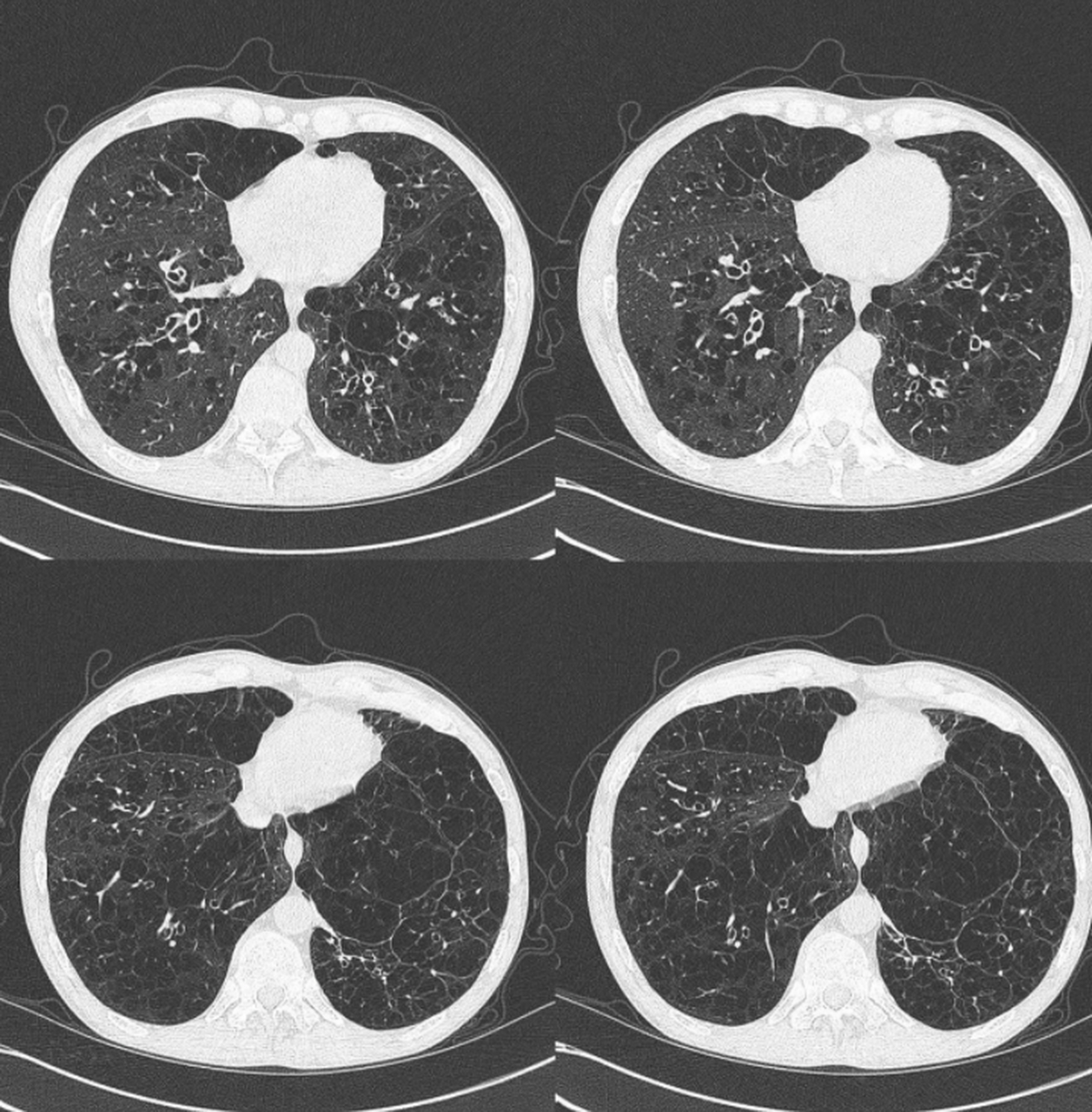 选择用中医药来治疗肺结节,肺气肿,肺大泡,慢阻肺,到底是不是交智商税