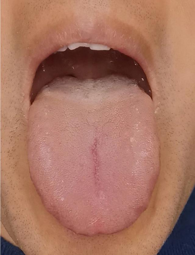 肝郁克脾,脾虚湿盛,他呢又习惯性的吃一些生冷肾阳虚什么舌苔图片