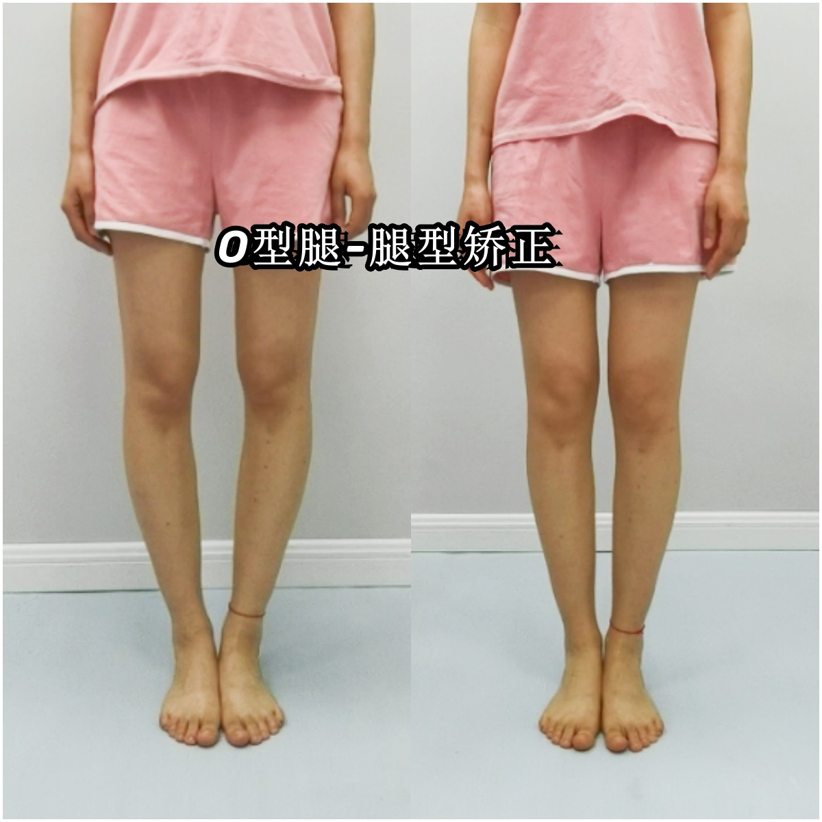 长期处于o型腿这种状态,对于下肢的整体力线会有极大的影响,继而导致