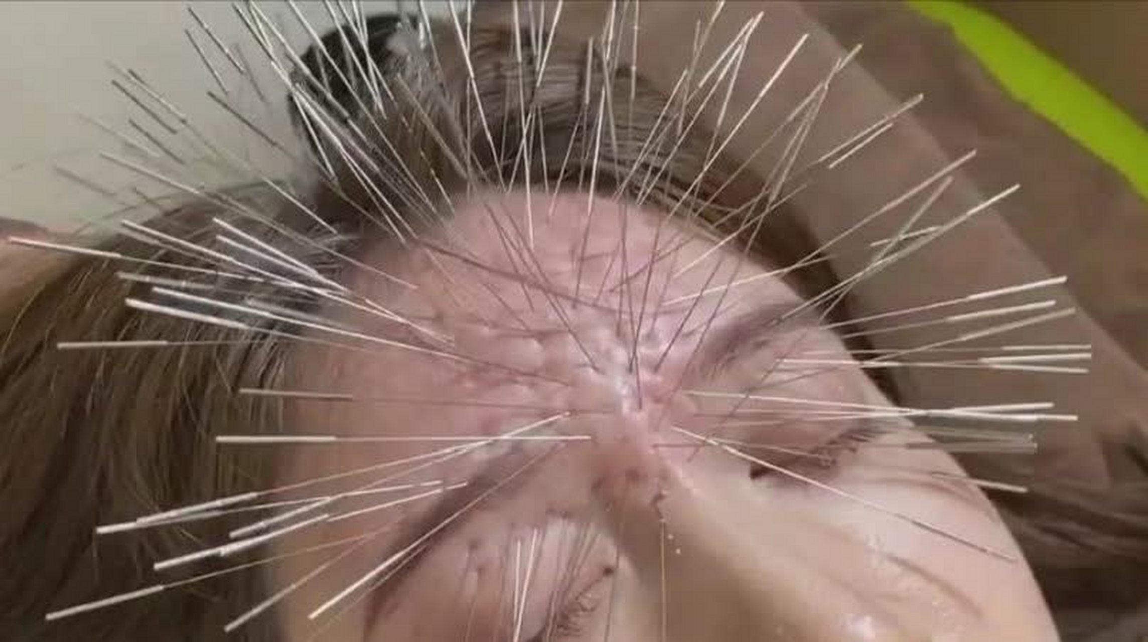 针灸已经约定俗成了,但是针怎么变成了刺猬呢?[滑稽]