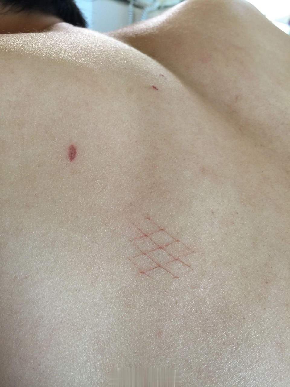 男人背上的伤痕