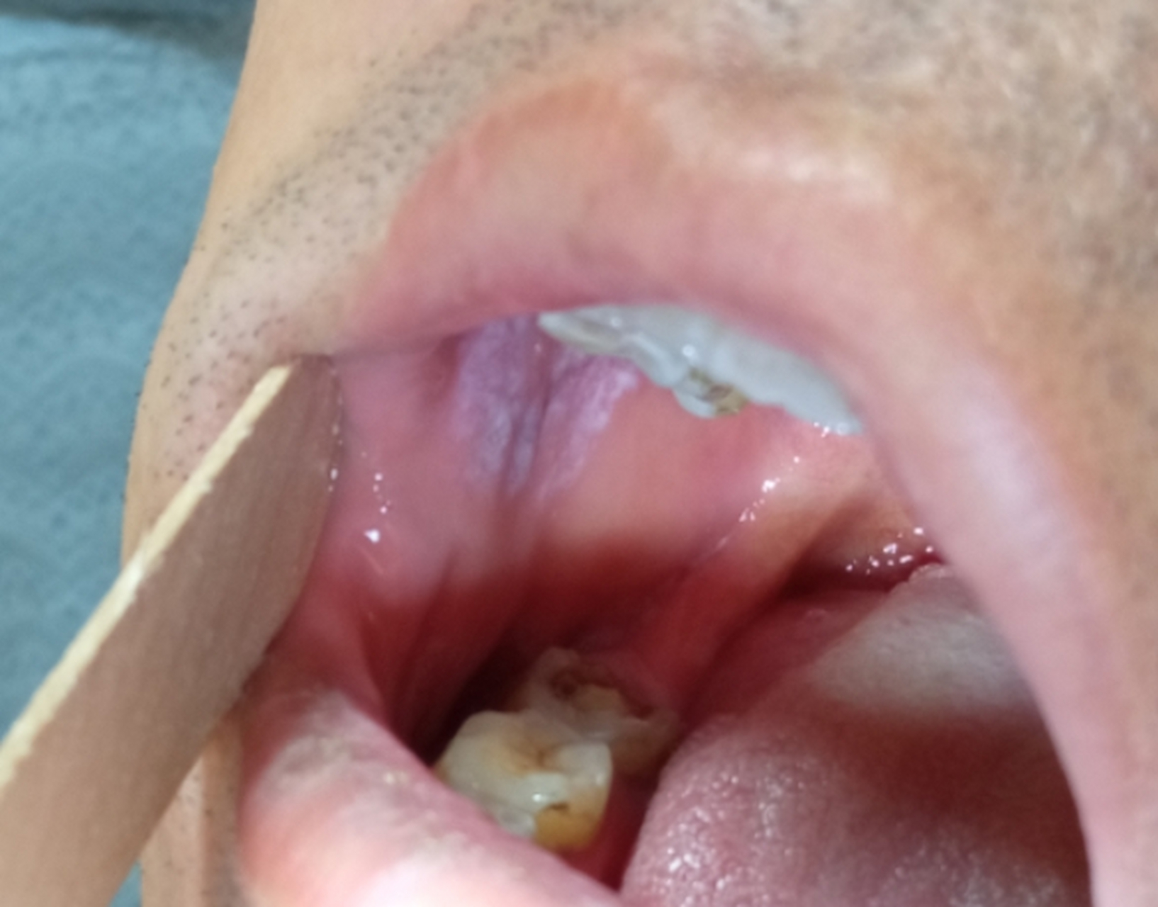 嘴里长白纹,舔起来跟粗糙,这其实是我们口腔黏膜科的一个顽疾,叫