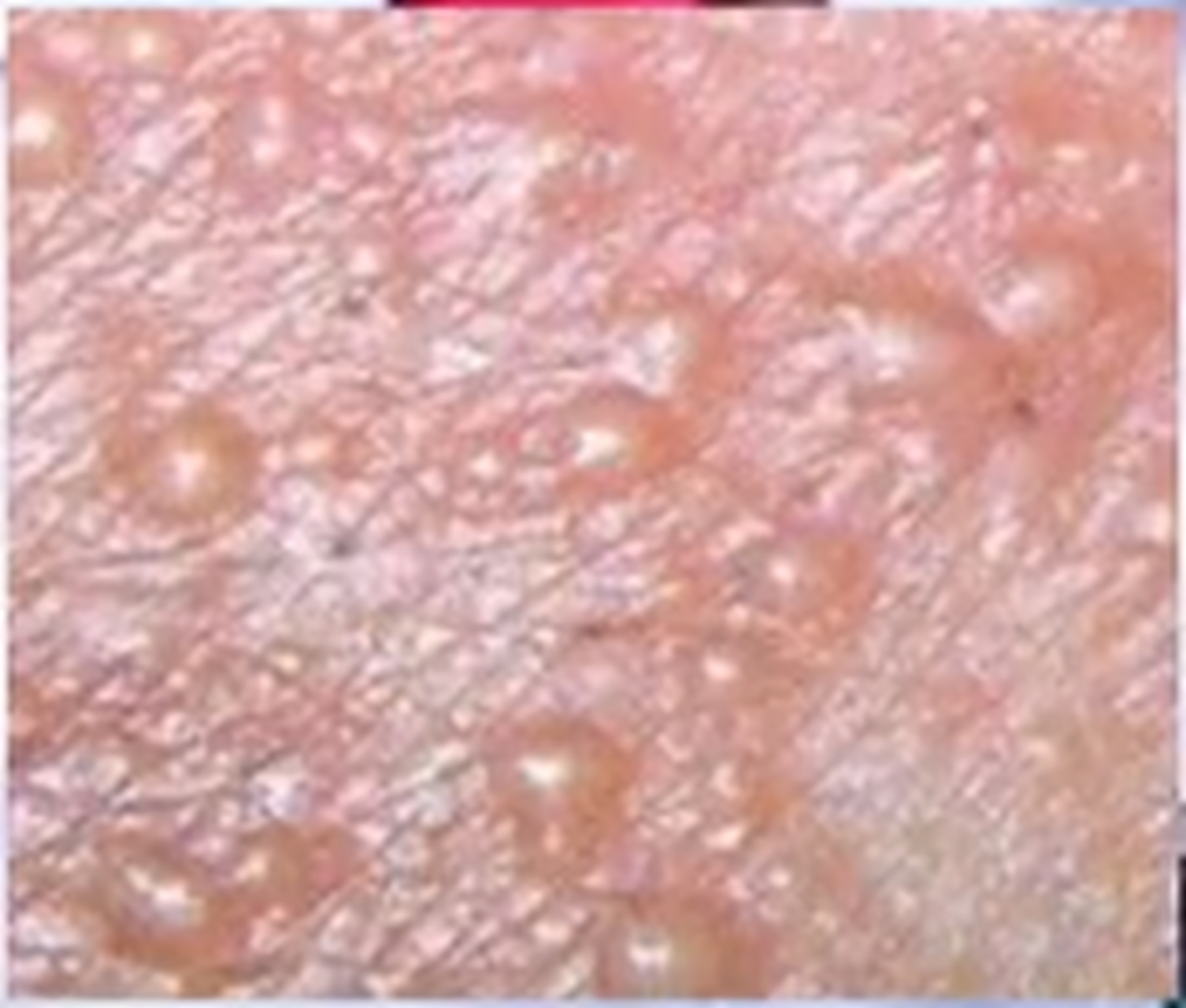 私处反复长水泡,这是x病,不好惹!