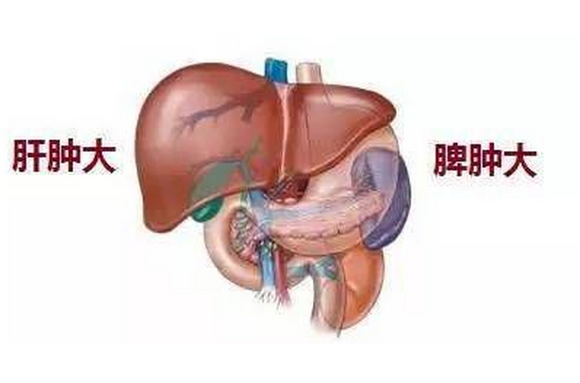 到了中晚期,也就是我们经常说的肝硬化失代偿期,一般会出现一个症状