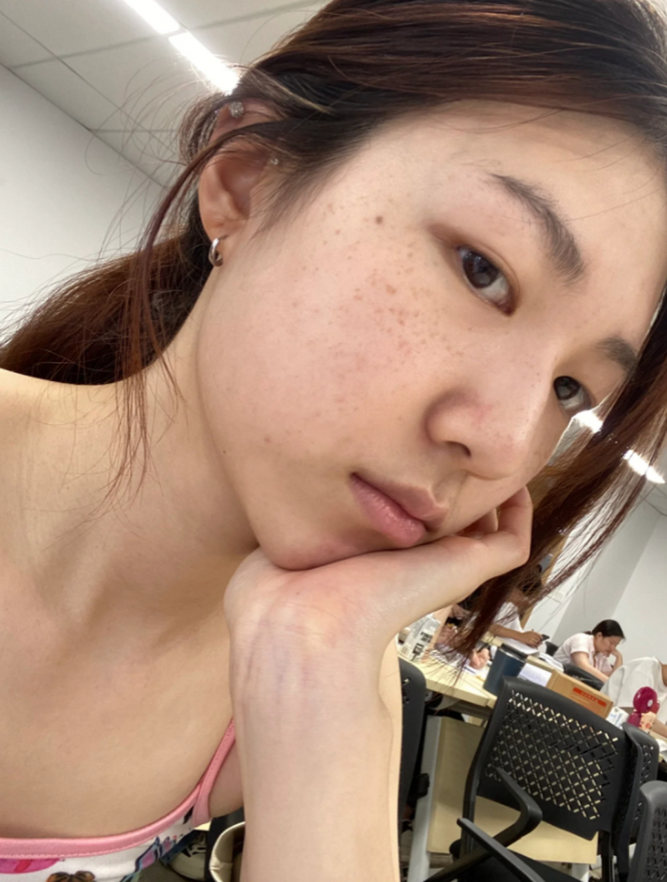 脸上祛斑最好的方法,目前最有效的方法 #医美科普挑战赛#  斑点是许多