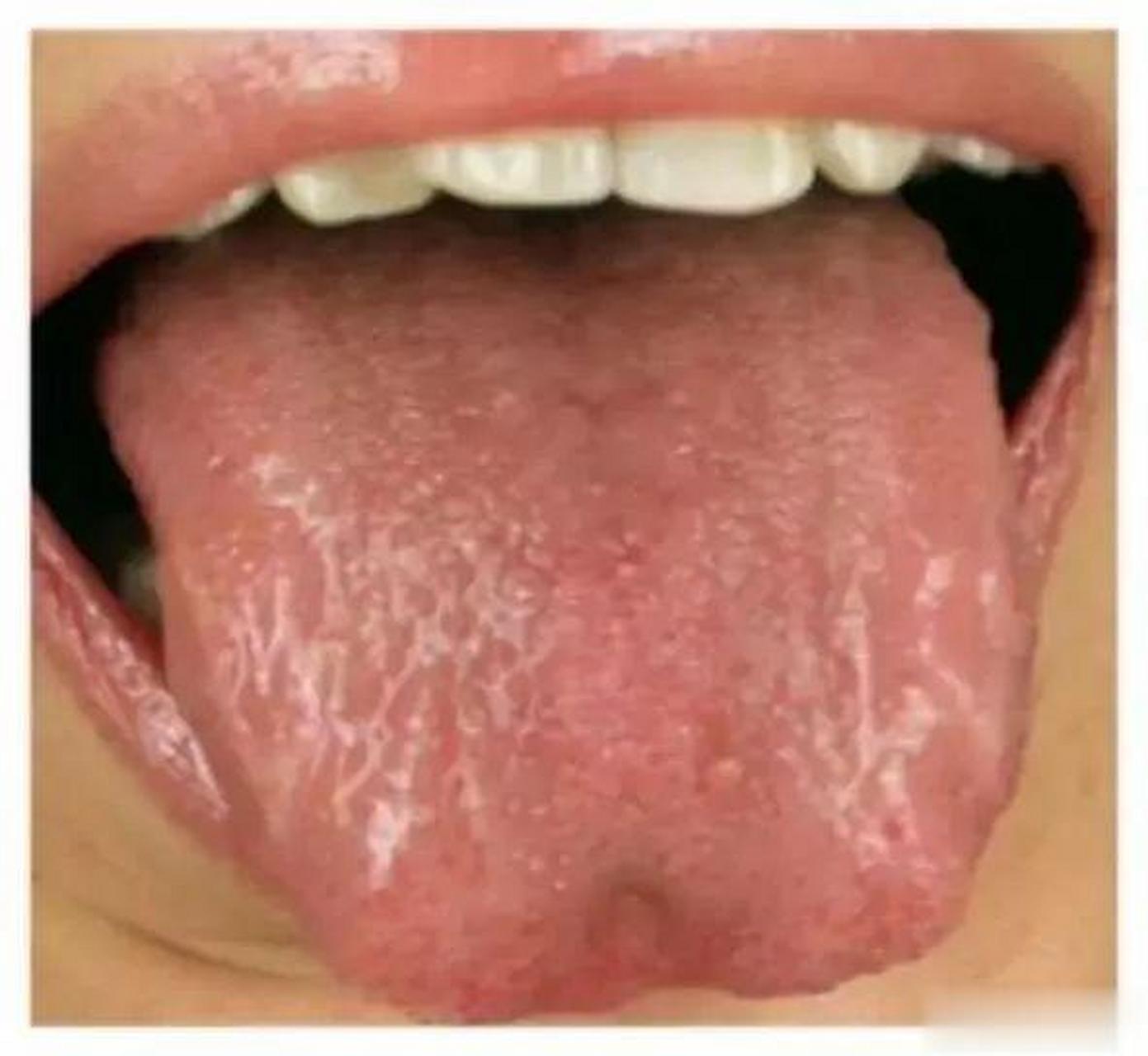 阴虚引起的上火,舌头一般不是很红,比正常舌头要红一点.