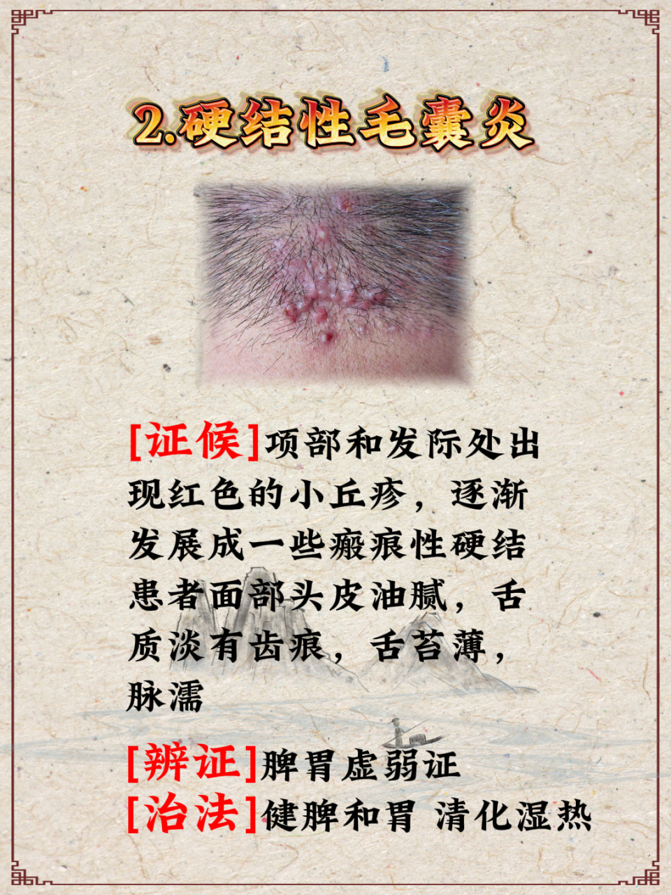 毛囊炎# #毛囊炎怎么治# #穿掘性毛囊炎# #马拉色菌毛囊炎# #头皮