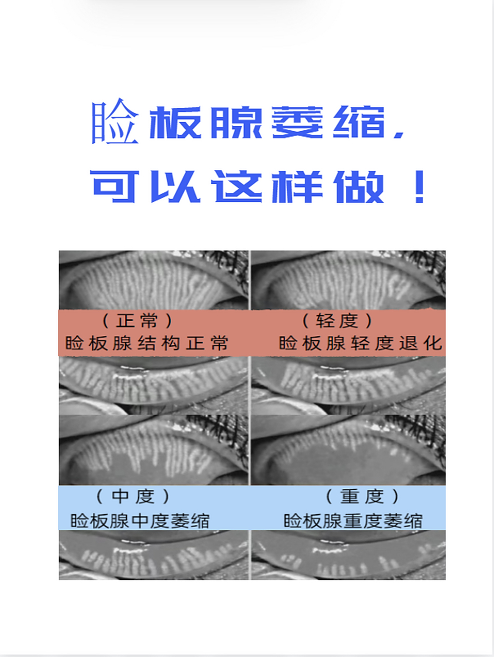 干眼症反反复复导致睑板腺萎缩!