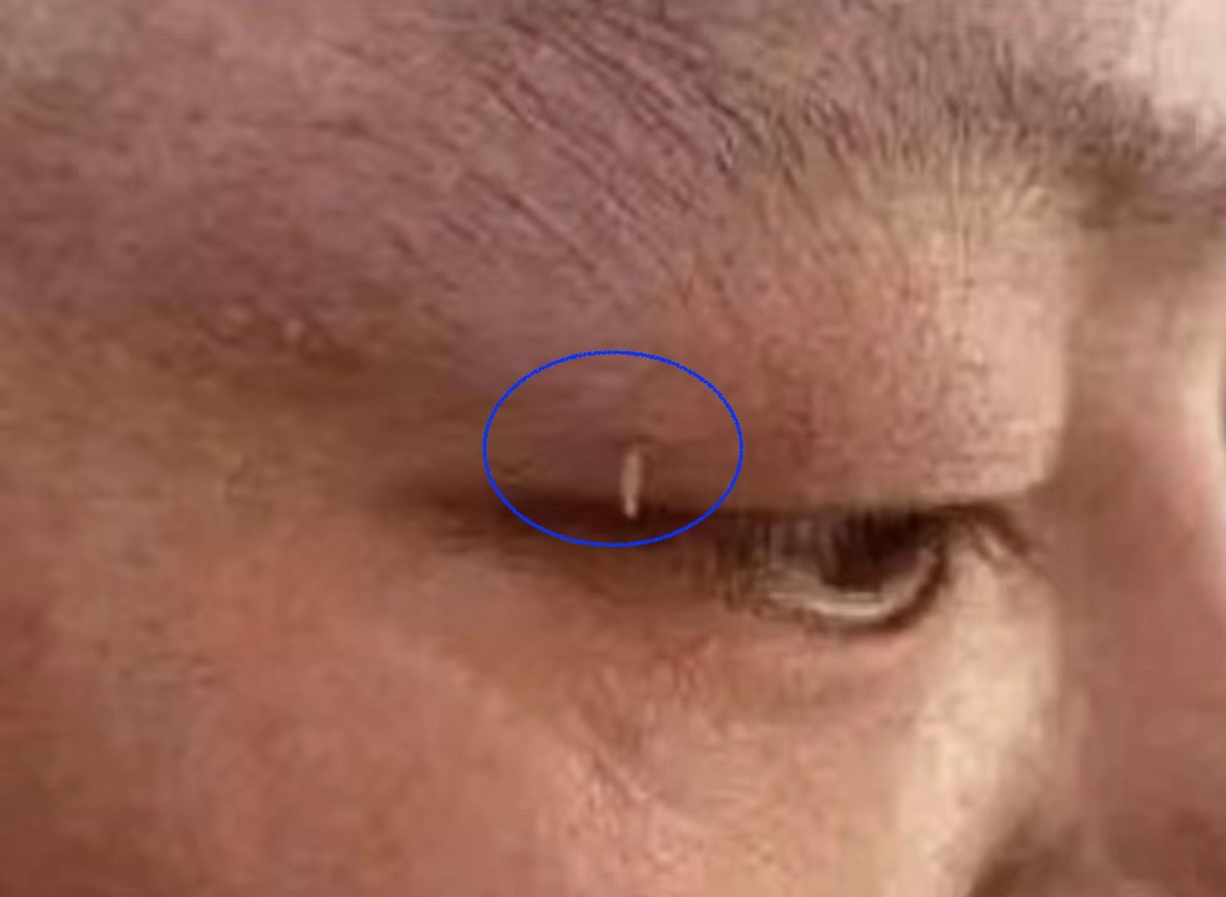 脖子和眼皮上长的小肉条,不疼不痒,注意别随意拔,以免长更多!