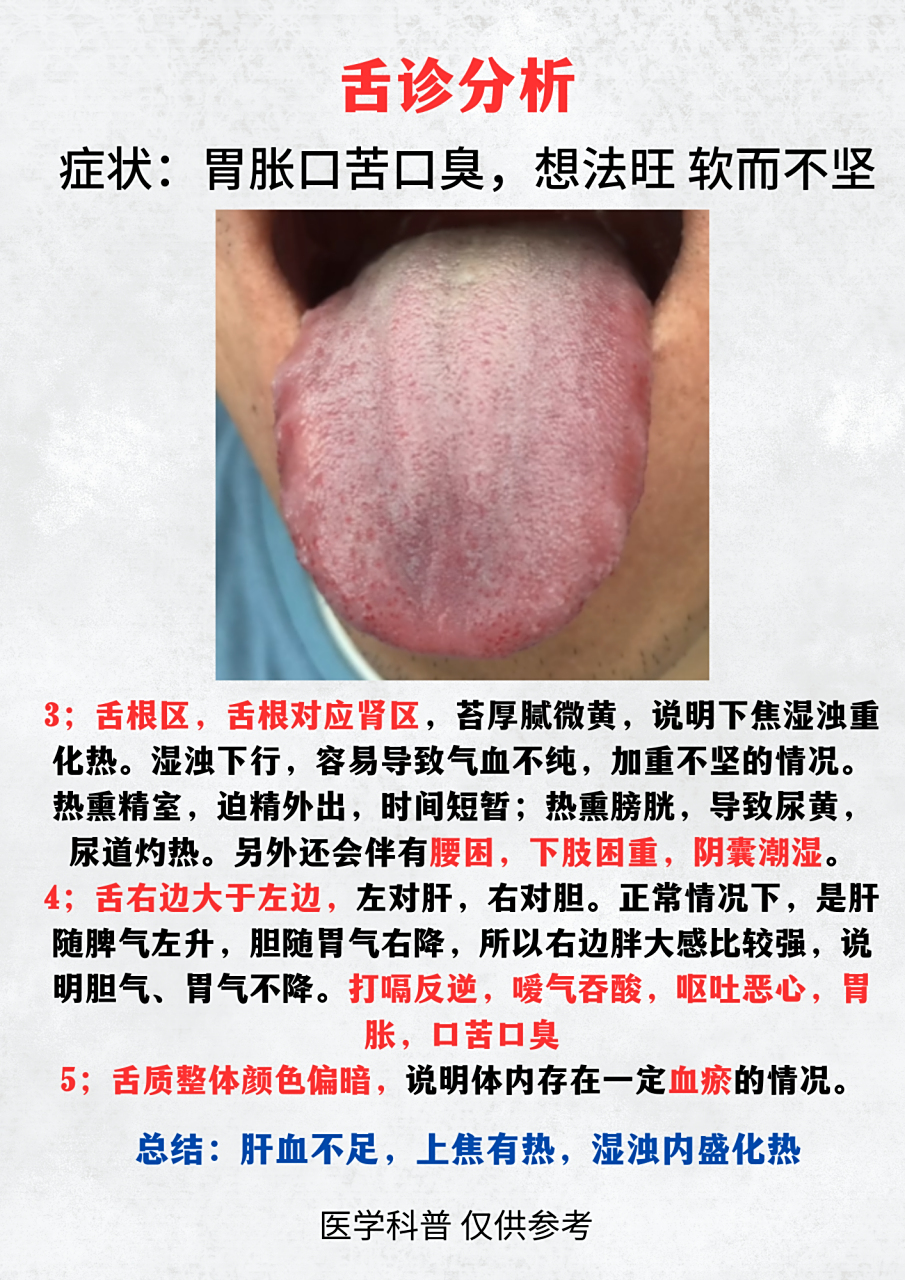 粉丝舌苔分析:  症状:胃胀,口苦口臭,想法强烈 软而不坚  你的舌苔是