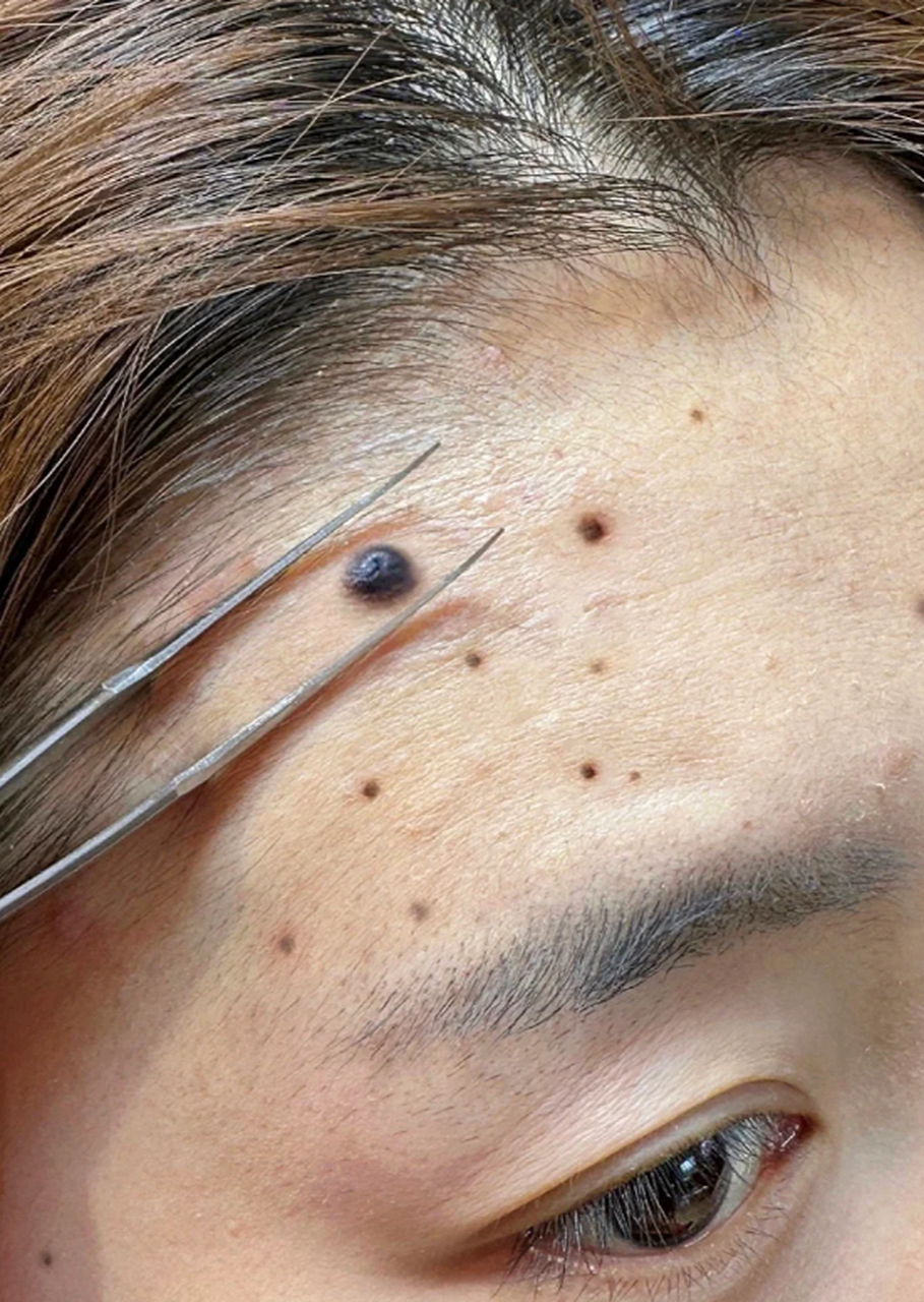 医美科普挑战赛#  凸起的黑痣是一种常见的皮肤问题,给人们带来一定
