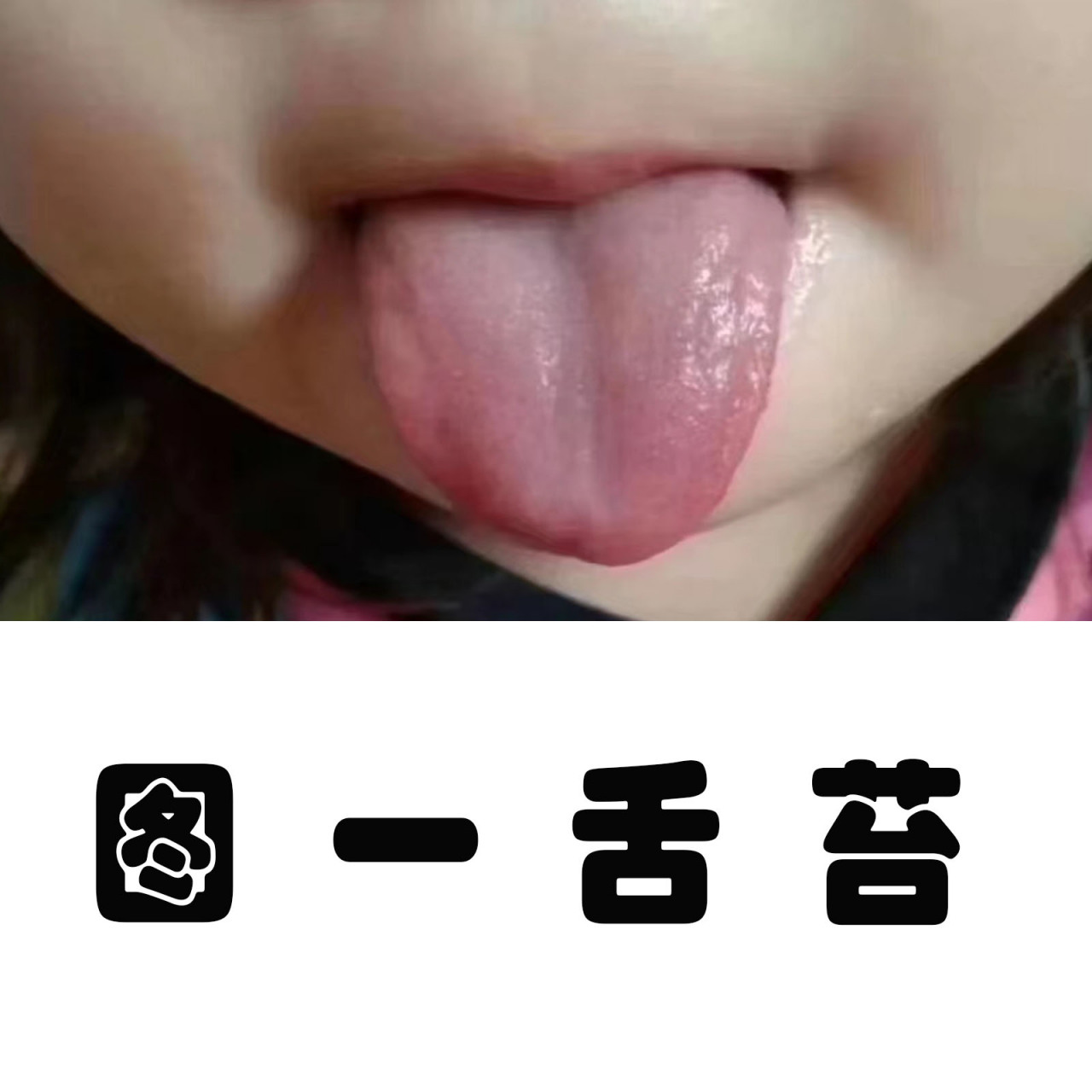 孩子舌苔是身体的晴雨表 图1:正常舌苔,淡红,薄白,由于咀嚼和吞咽动作