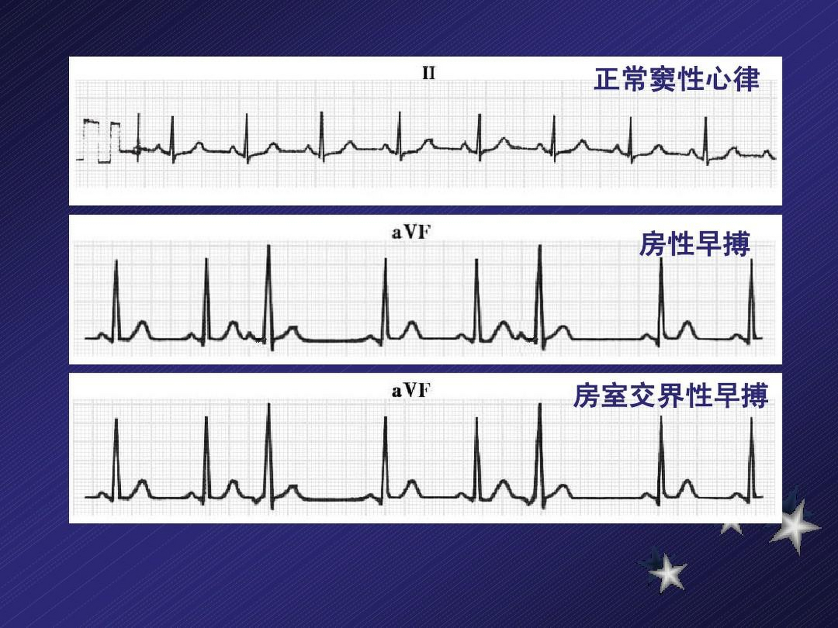 房室交界区图片