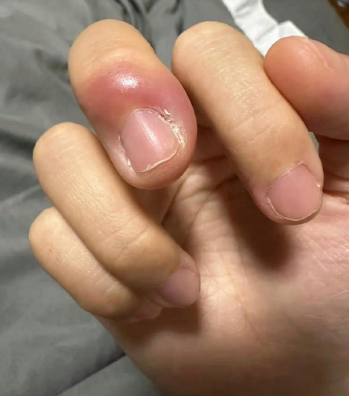 千万不要随意拔手上的倒刺!