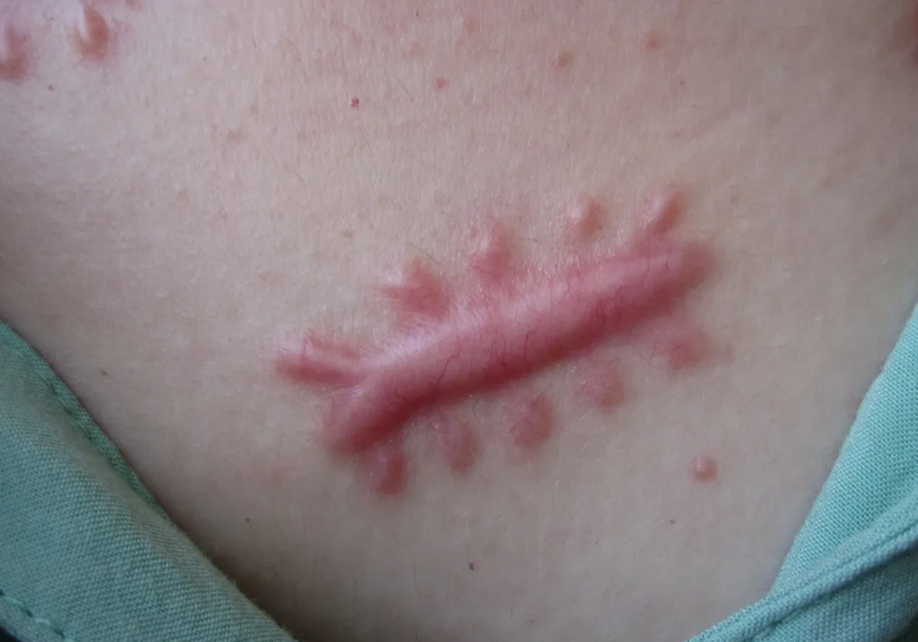 蜈蚣咬后的伤口形状图片