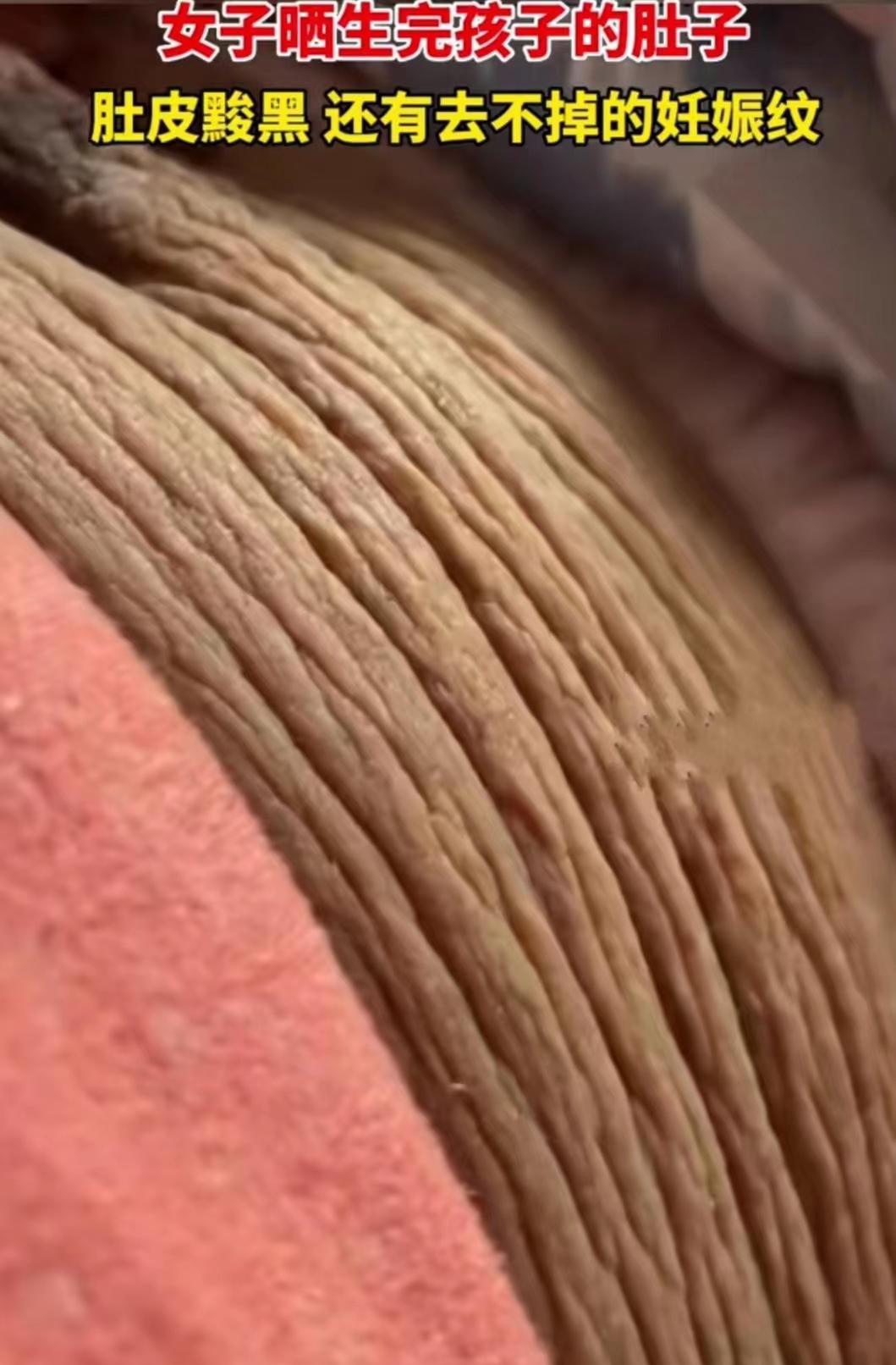 女人生完孩子后的肚子,全都是妊娠纹,好辛苦