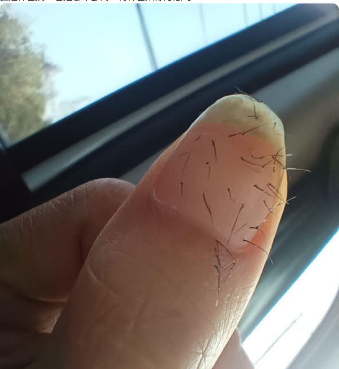 这是什么怪病,指甲都长毛了?[捂脸]