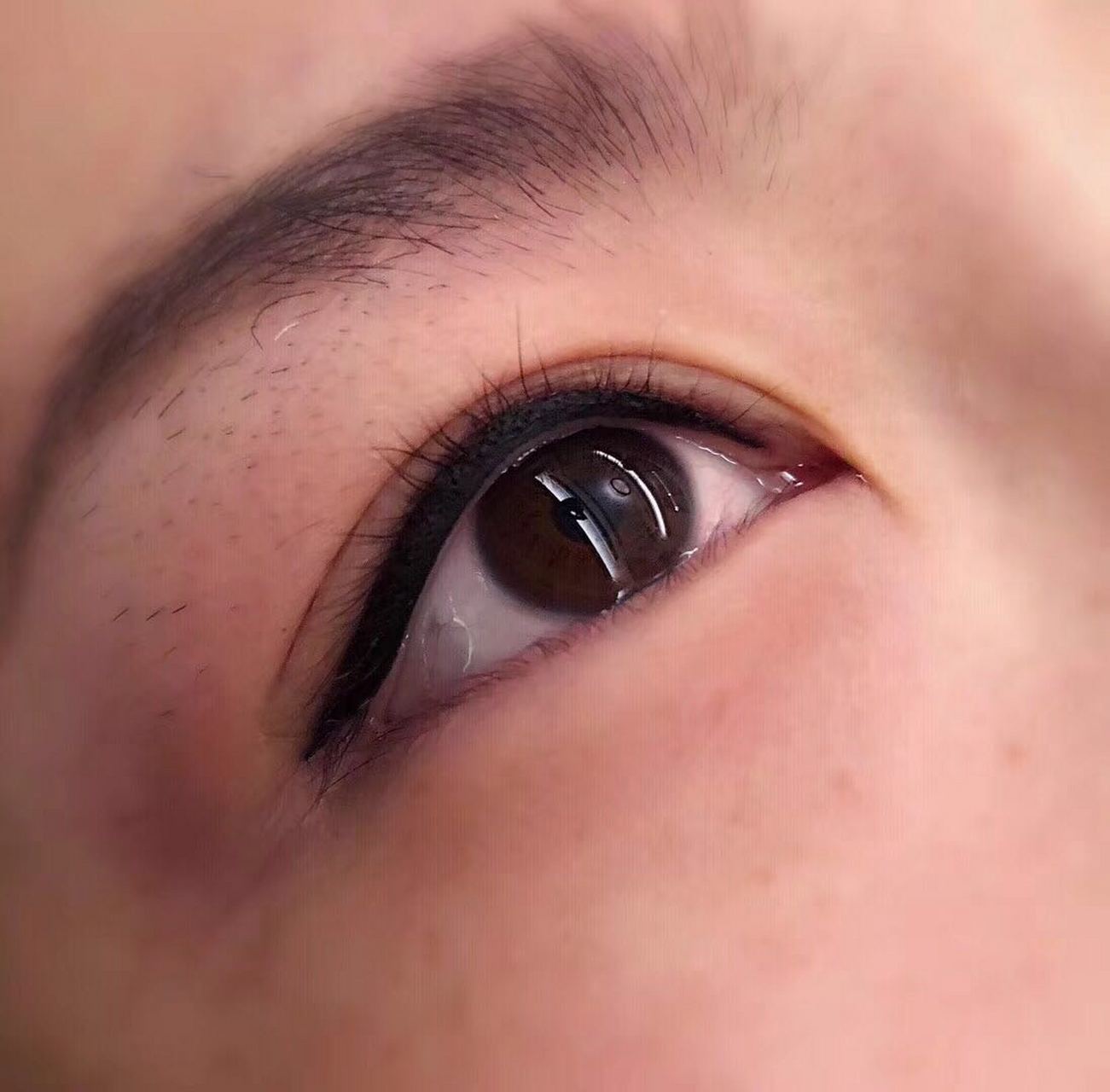 纹美瞳线后,眼睛肿胀怎么办?