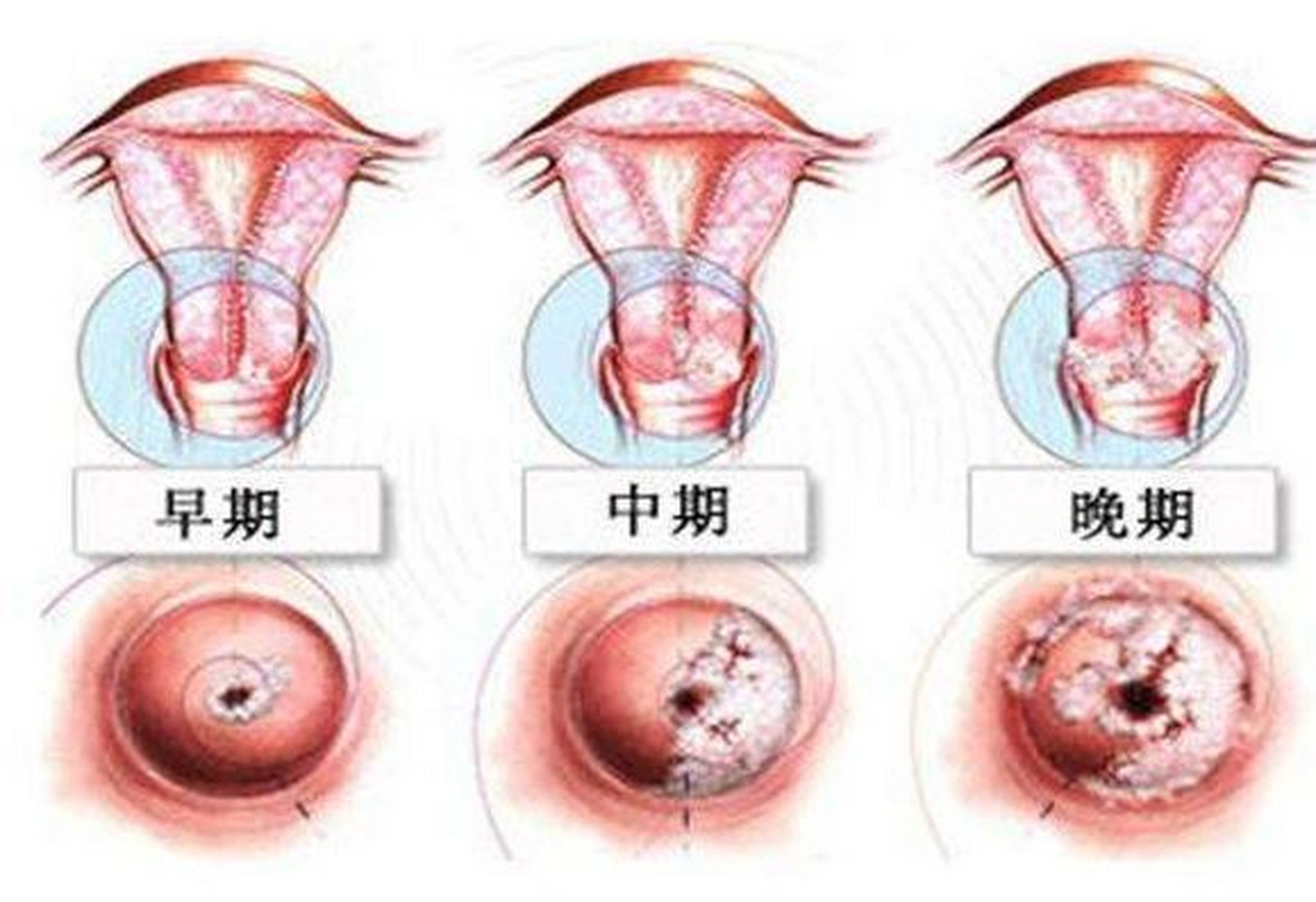 宫颈癌出血特点图片