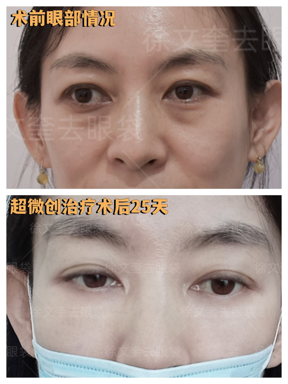 多数人因为对去眼袋技术不了解,心里会害怕和担心,主要体现在手术