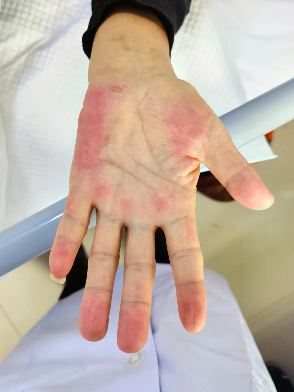 肝硬化#   这种肝掌常见于慢性肝病患者,表现为手掌的大小鱼际处皮肤