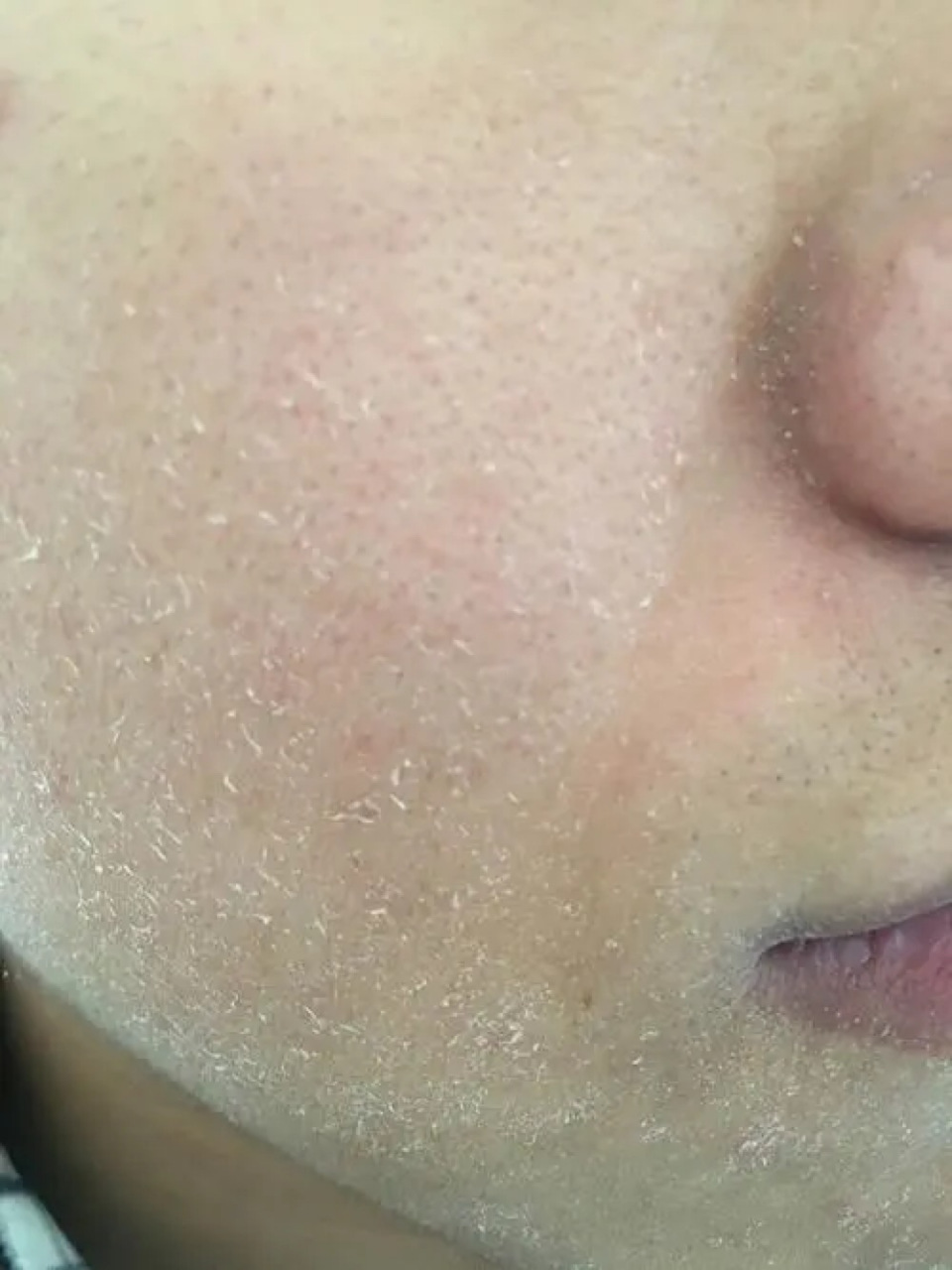 还是面部皮肤粗糙,要解决这个问题需考虑以下几个方面:  定期去角质