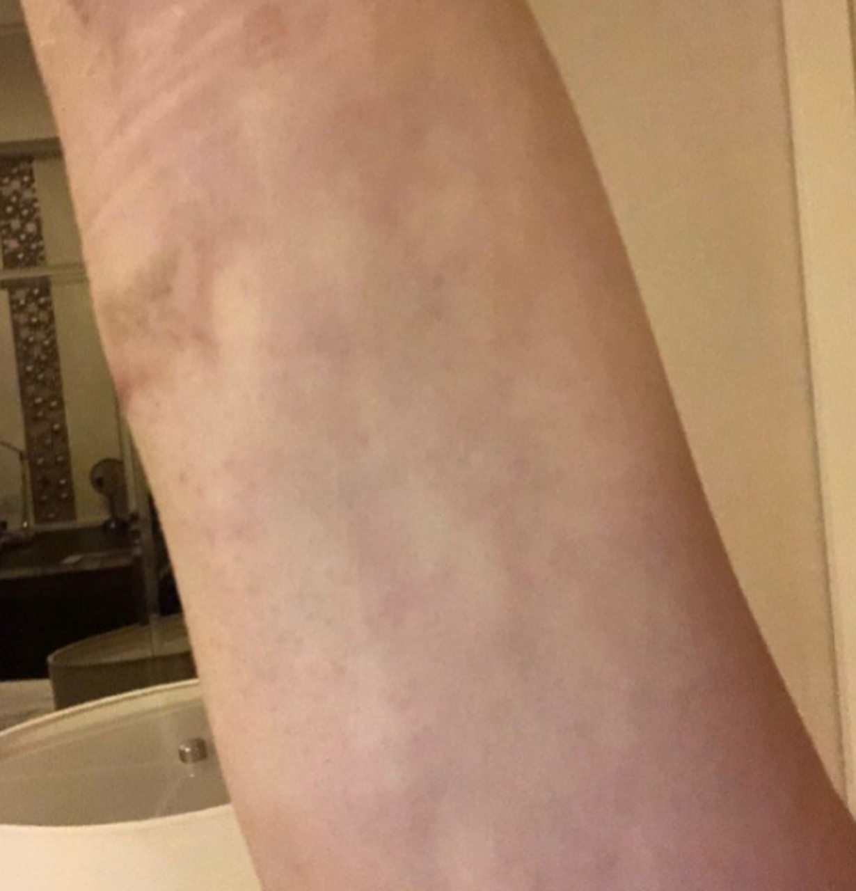 给做完吸脂手术不久出现了凹凸不平的朋友一个建议!