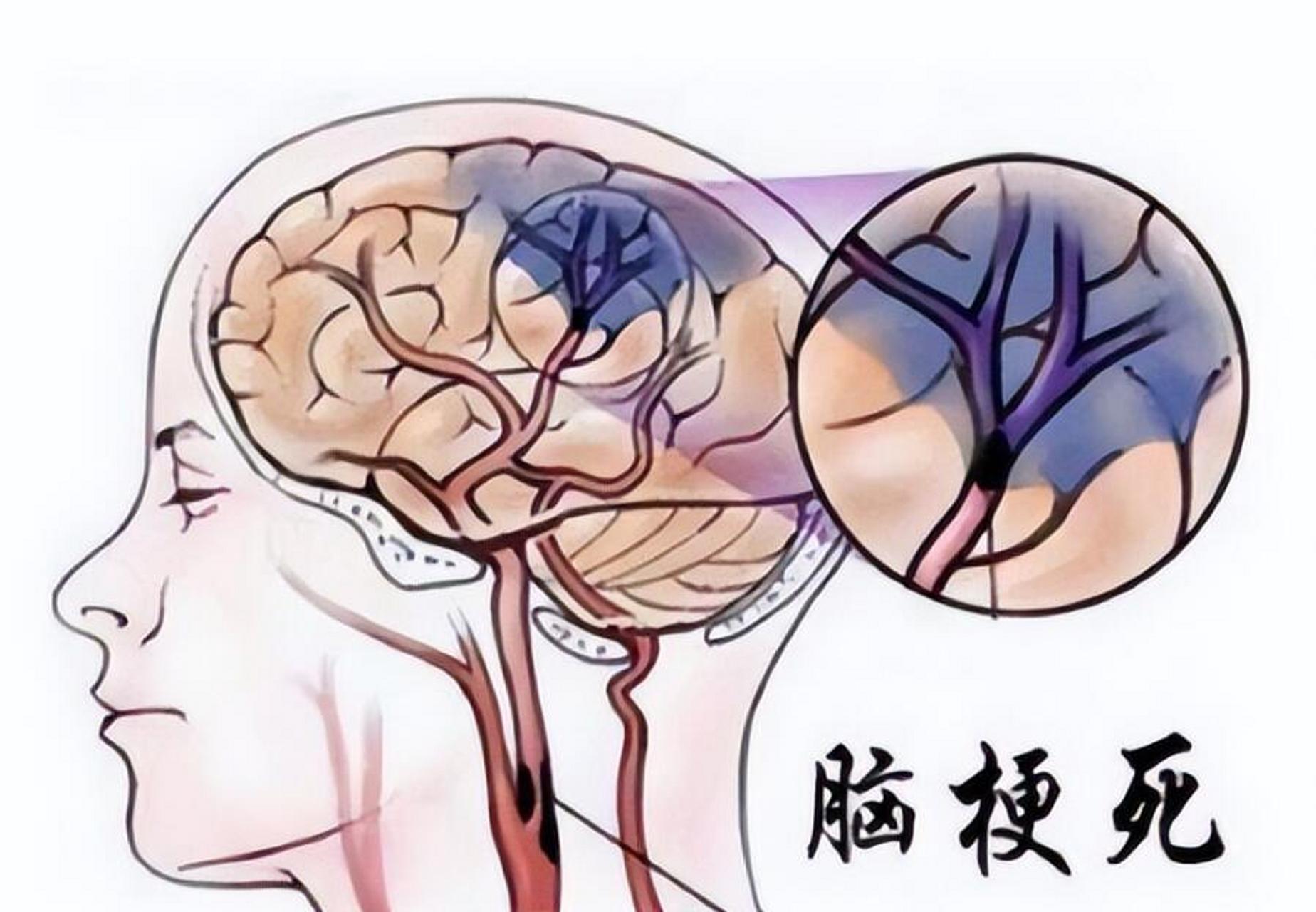 什么是腔隙性脑梗死,比脑梗死谁更严重 腔隙性脑梗