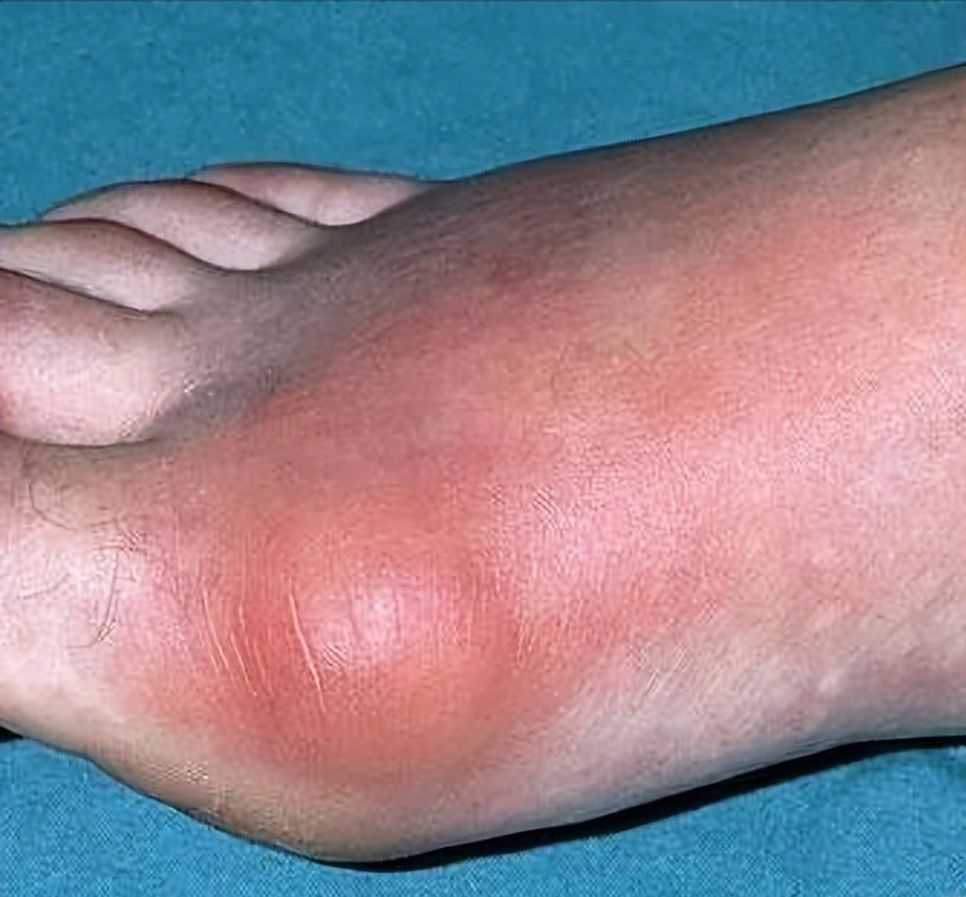 王先生昨天夜里在睡梦中,突然感觉右脚火烧样剧烈疼痛,起来一看脚趾头