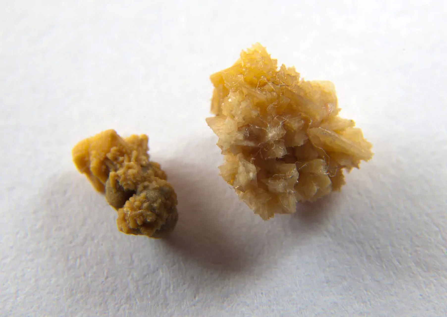 02 今天,我就来给大家讲讲【肾结石的分类,以及肾结石与真石头的