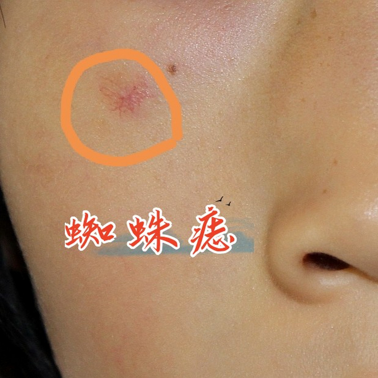 那我们如何区分自己是否是肝掌和蜘蛛痣?廖医生带你识别!