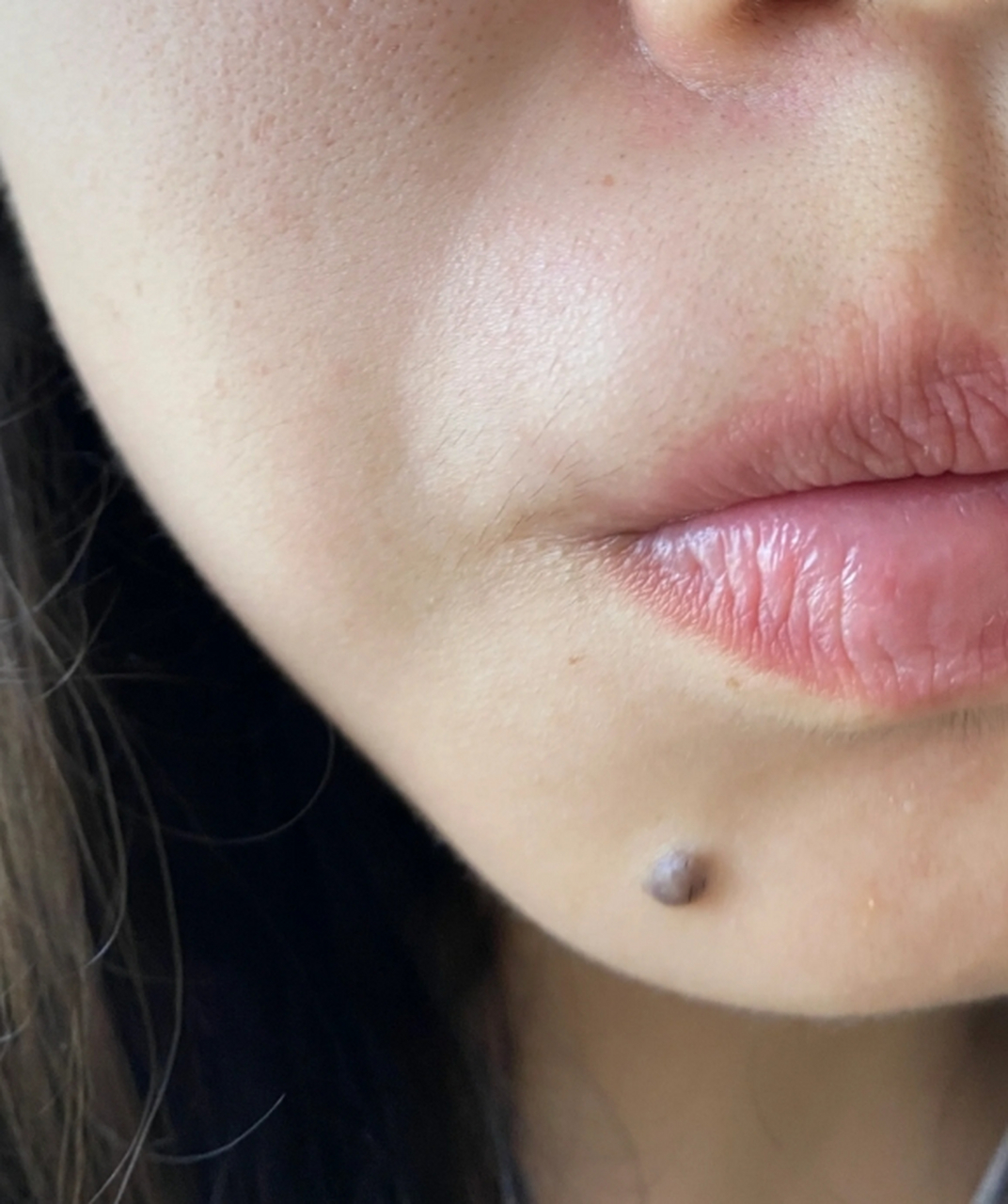 肉痣,也被称为丘疹状痣或血管瘤,是一种常见的皮肤病变,通常呈圆形或