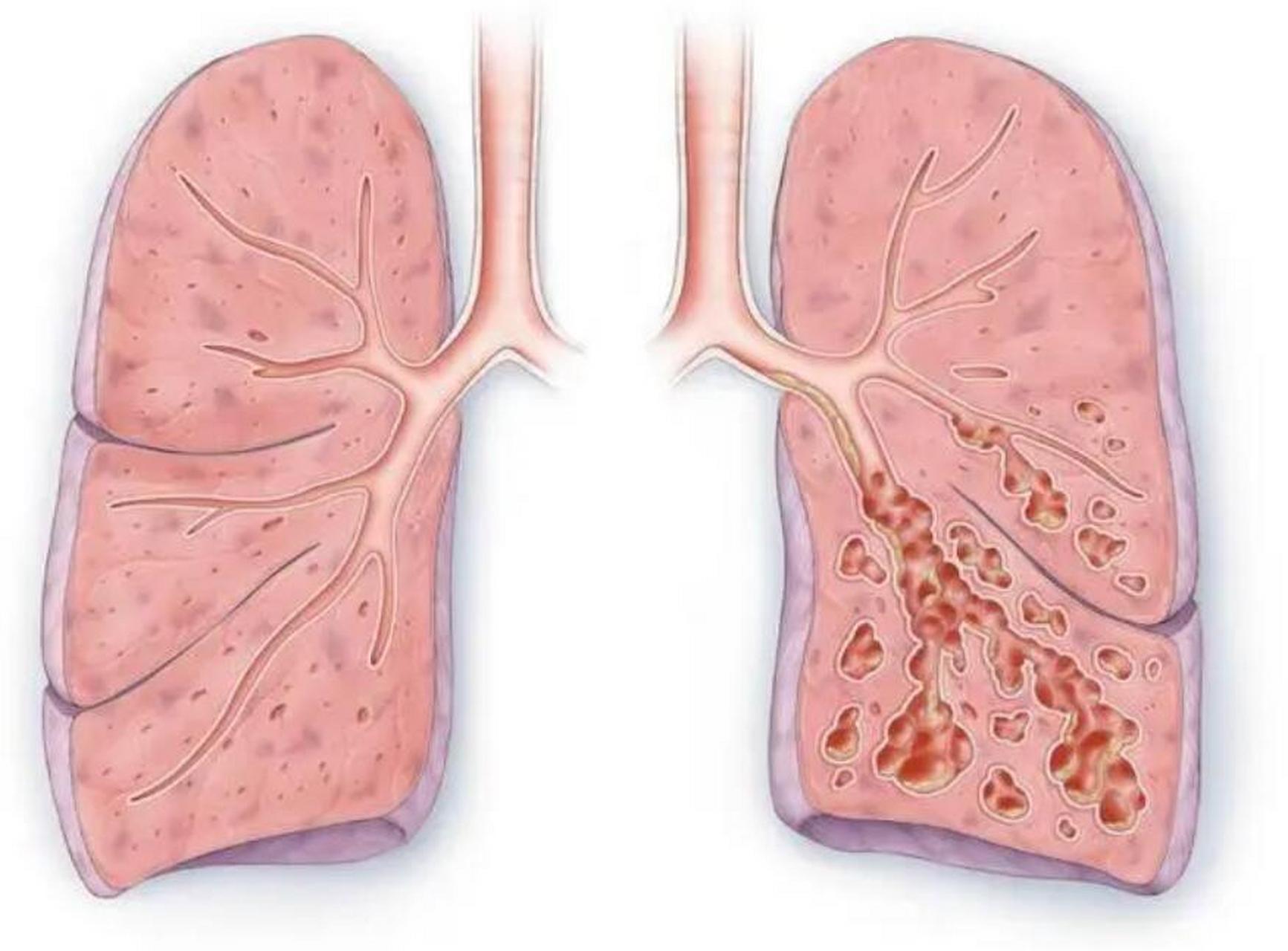 教你三种方法,把支气管扩张产生的痰排出来 支气管