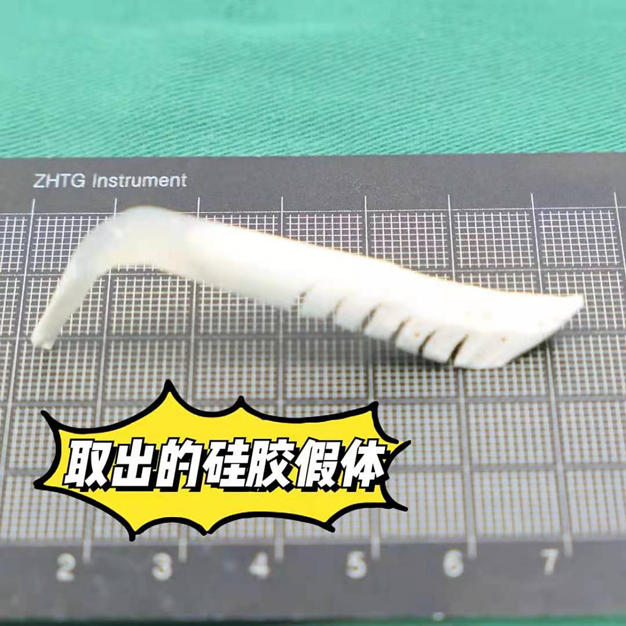 取出的崭新l硅胶假体 从这位小伙子的鼻子里取出的l型硅胶假体(如图2)