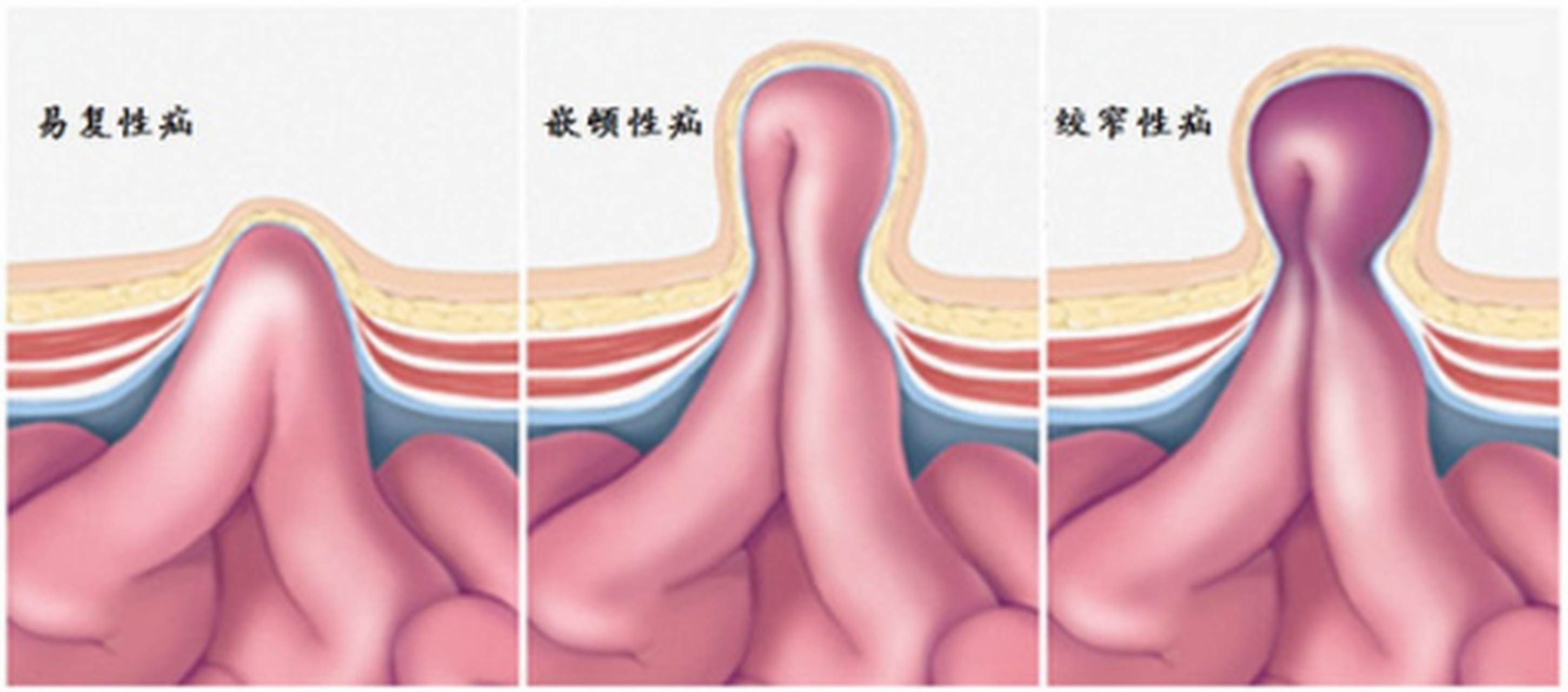 小肠气是什么病图片