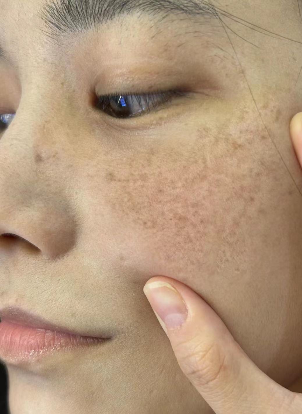 怎样有效去除是很多人面临的美容难题,它不仅会让人看起来肤色不均匀