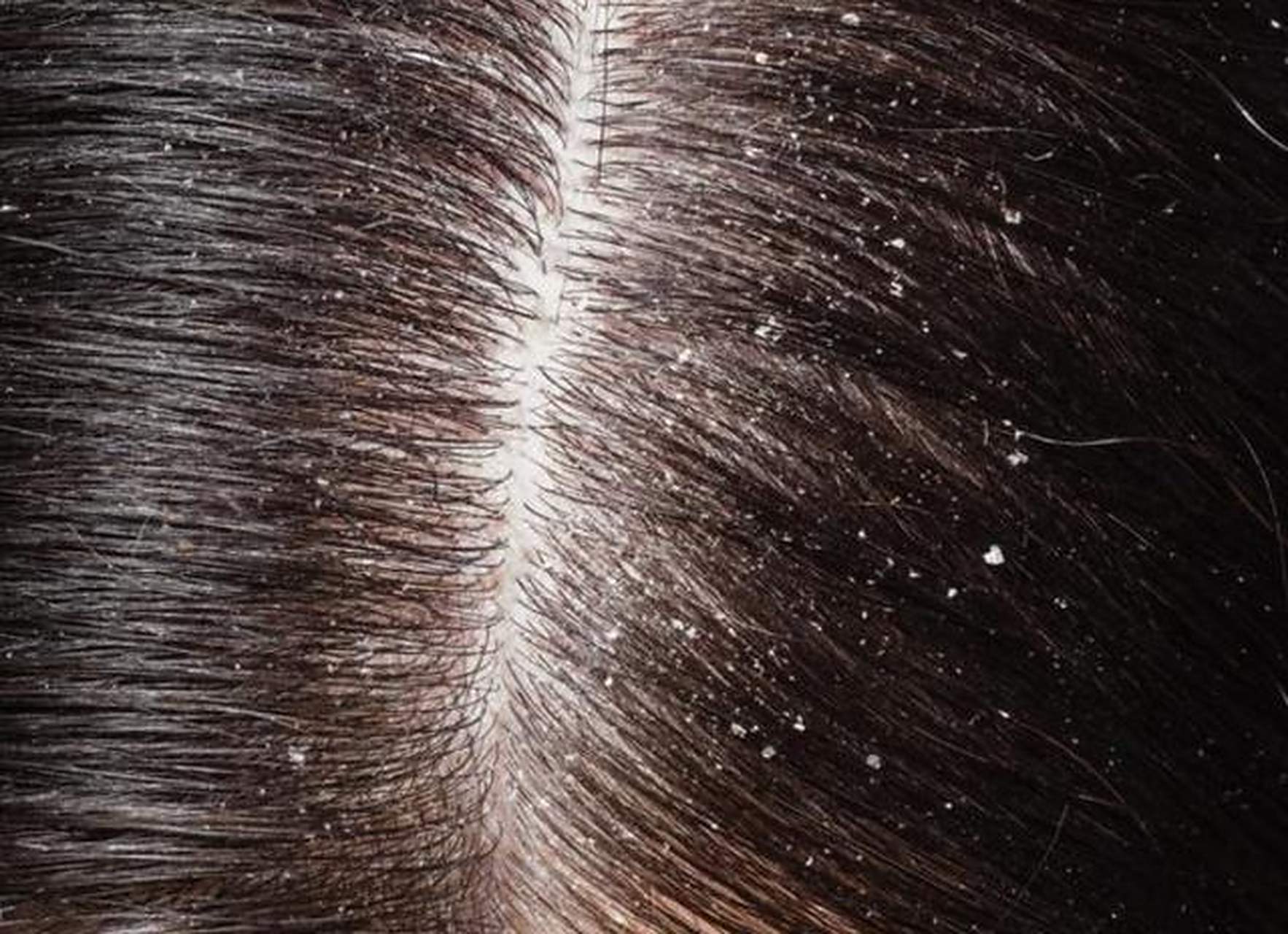 夏季头皮油,头屑多,不及时洗头,就会造成头皮油脂堆积,头上出现一些