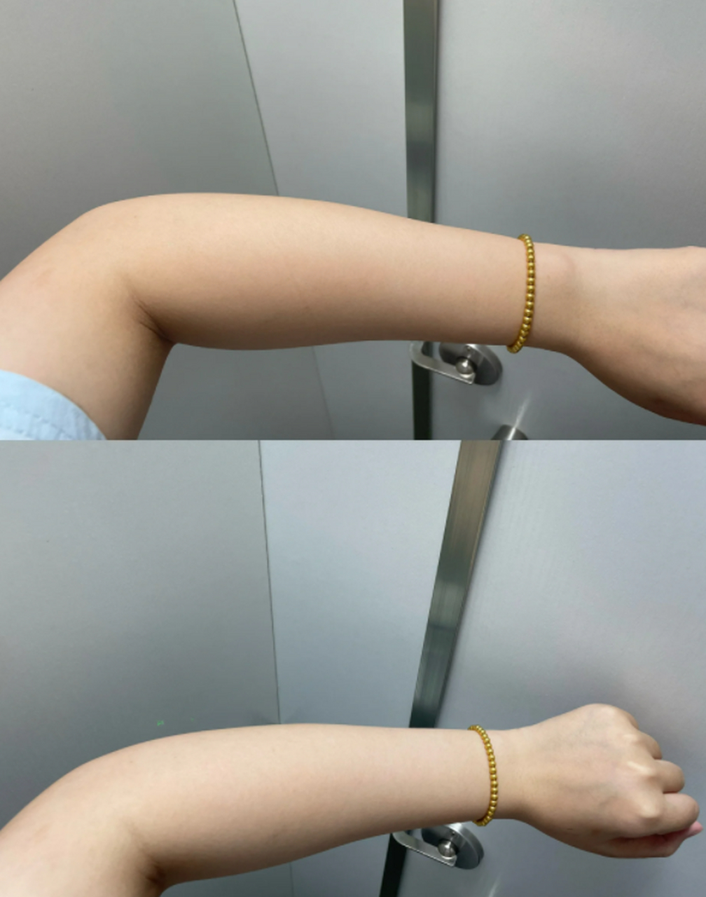 镭射美白是一种通过激光技术来改善肌肤色斑和提亮肤色的美容方法