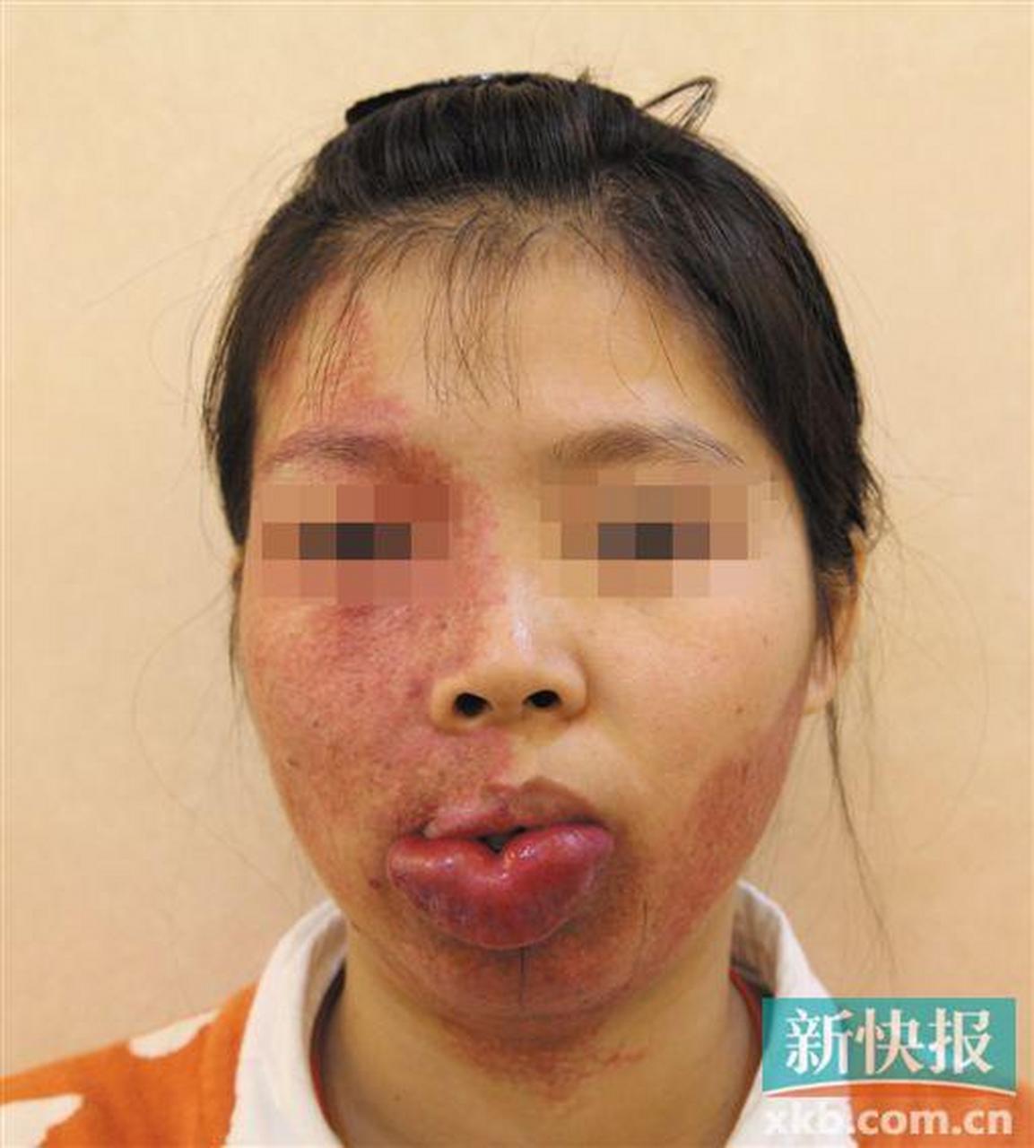 鲜红斑痣属于毛细血管瘤的一种,真皮层毛细血管异常扩张,部分红胎记