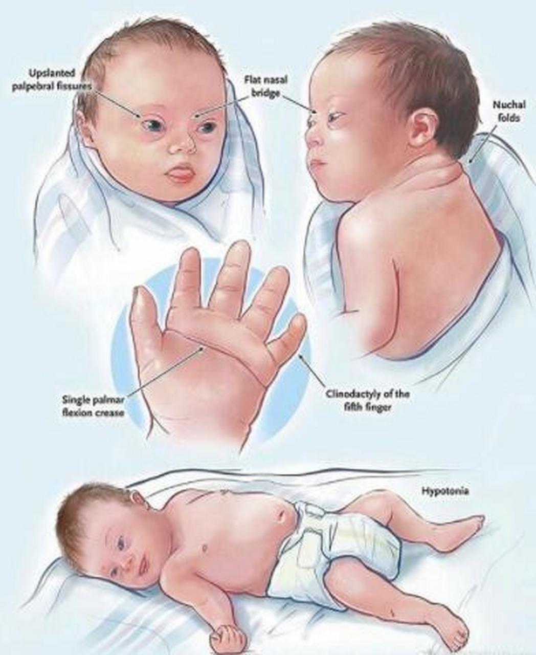 二十一三体综合症婴儿图片