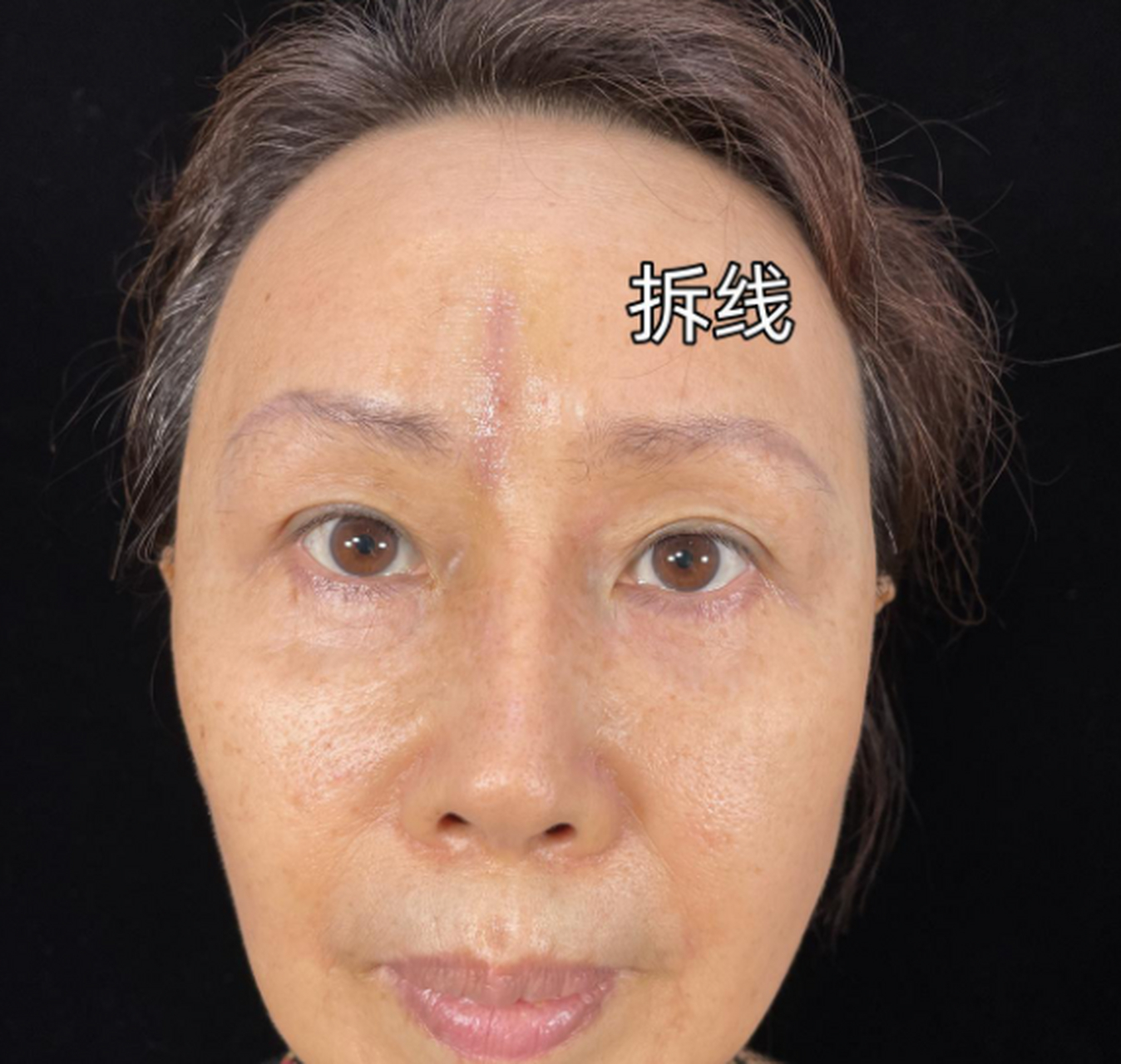 切除川字纹手术做完后,千万不要着急看效果,它是有一段恢复期的,要