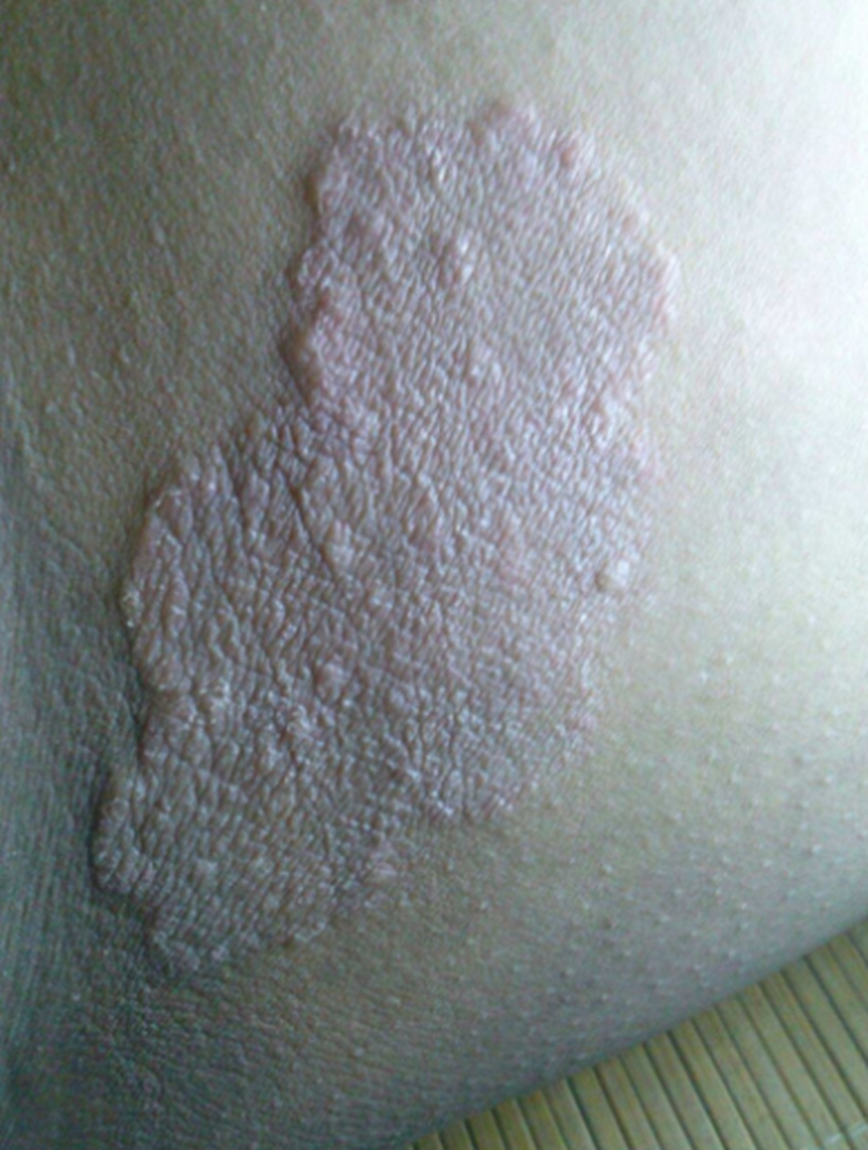 股癣是什么 你的大腿和臀部总是痒吗?