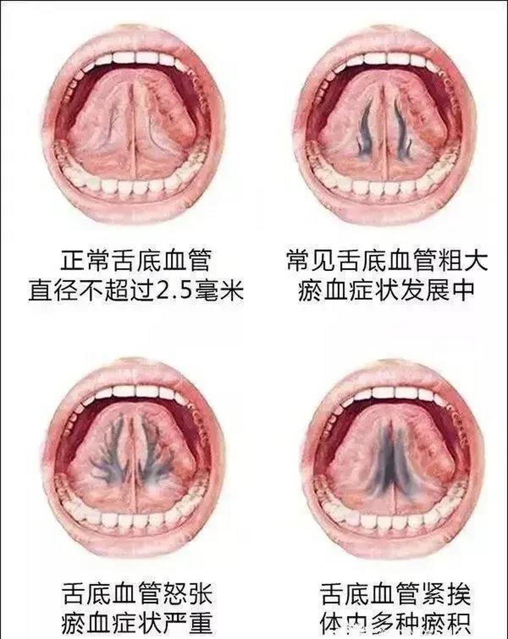中医舌下脉络的秘密