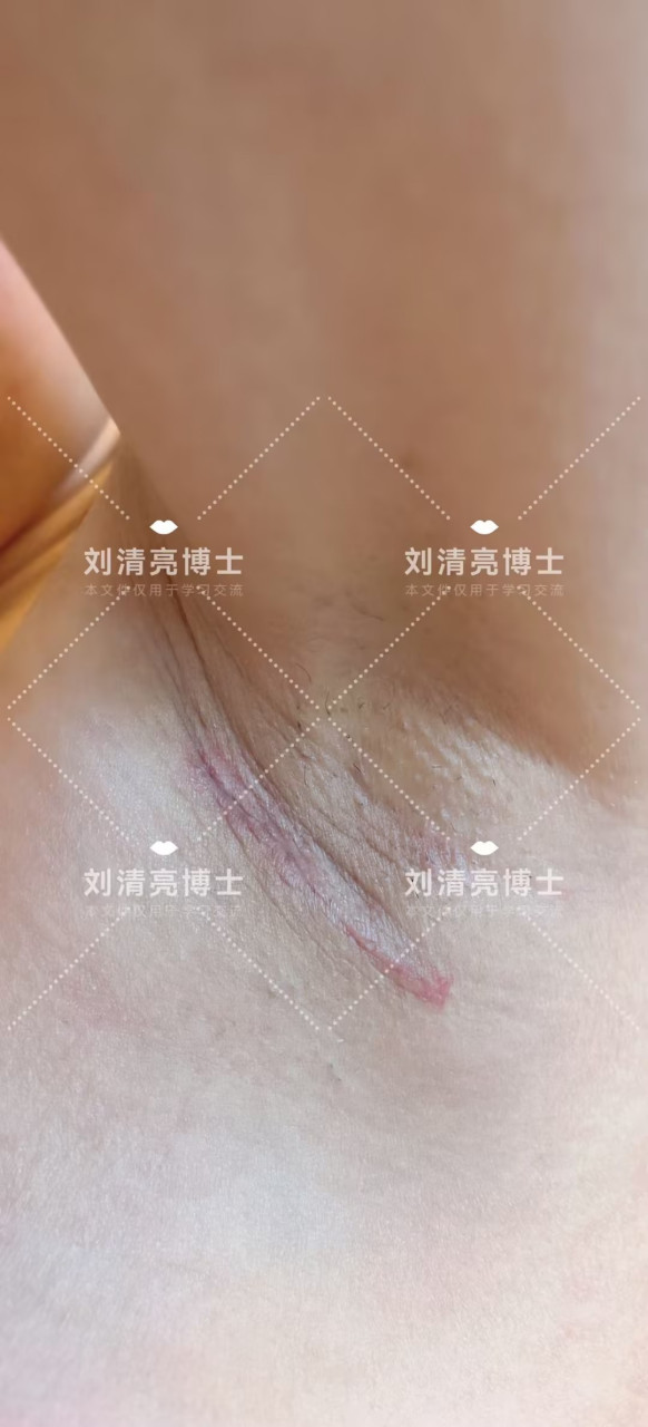 另外就算同是腋窝切口,也大有文章,希望大家多学习一点知识.